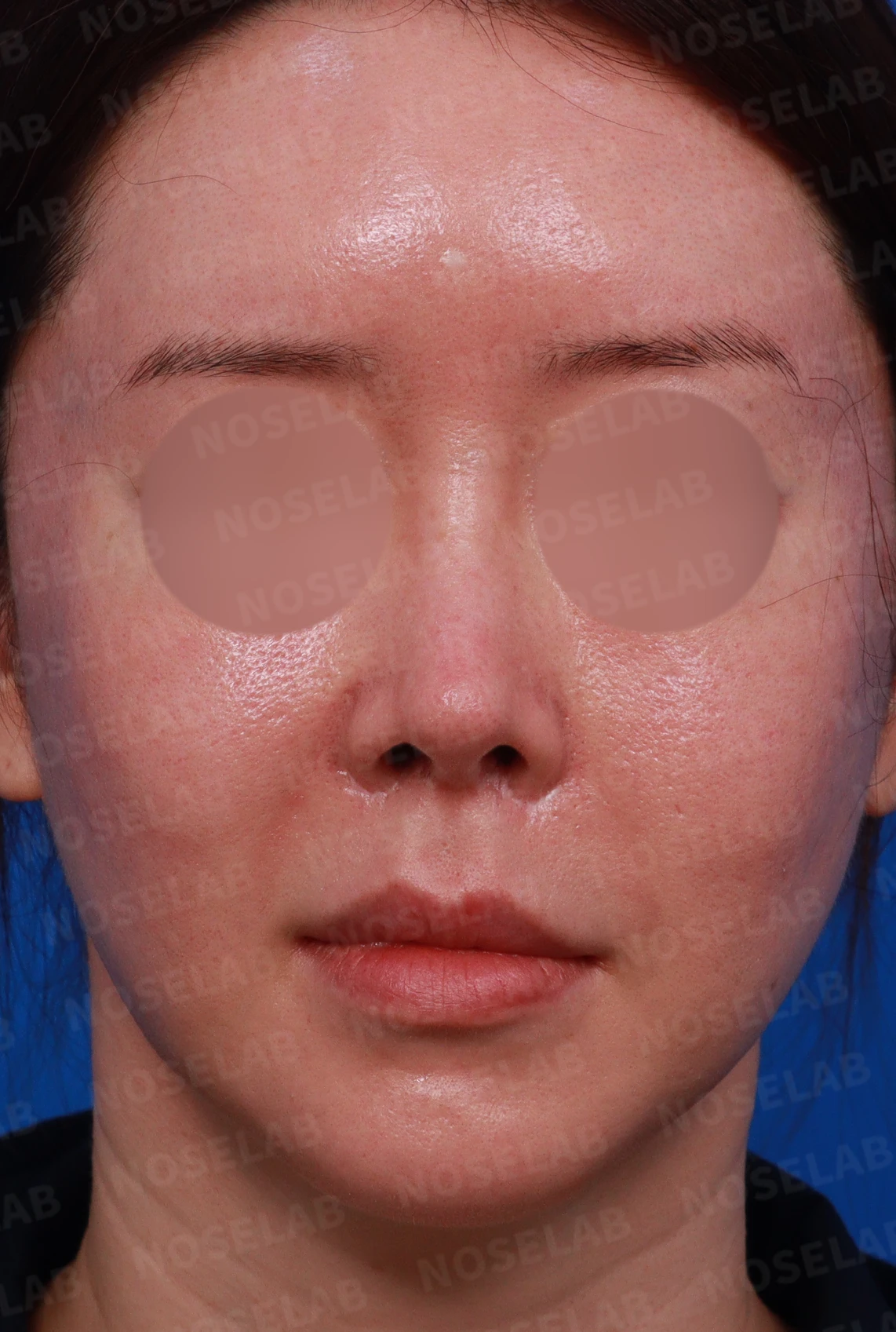 반복 수술 후 들창코와 반버선코를 교정하는 방법 — 수술전 디자인 상담 정면, 우측 측면, 비스듬한 측면 사진입니다.