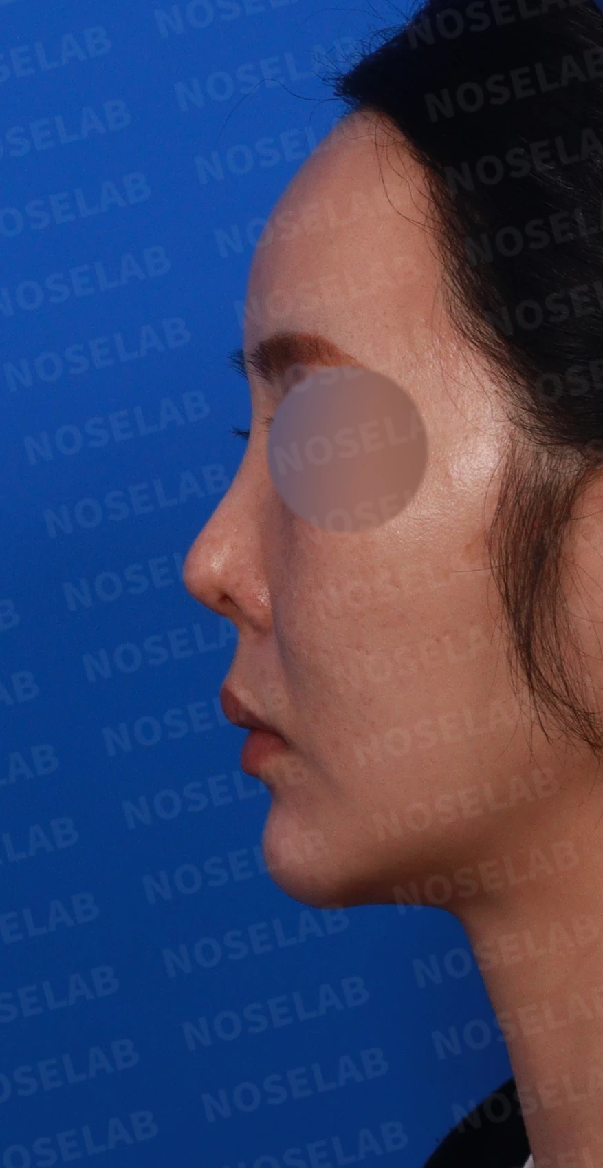 들린 코에서 콧구멍이 삼각형으로 드러나는 이유, 비공 모양 교정은 어떻게 하나 — 디자인 상담 정면, 좌측 측면, 비스듬한 측면 사진