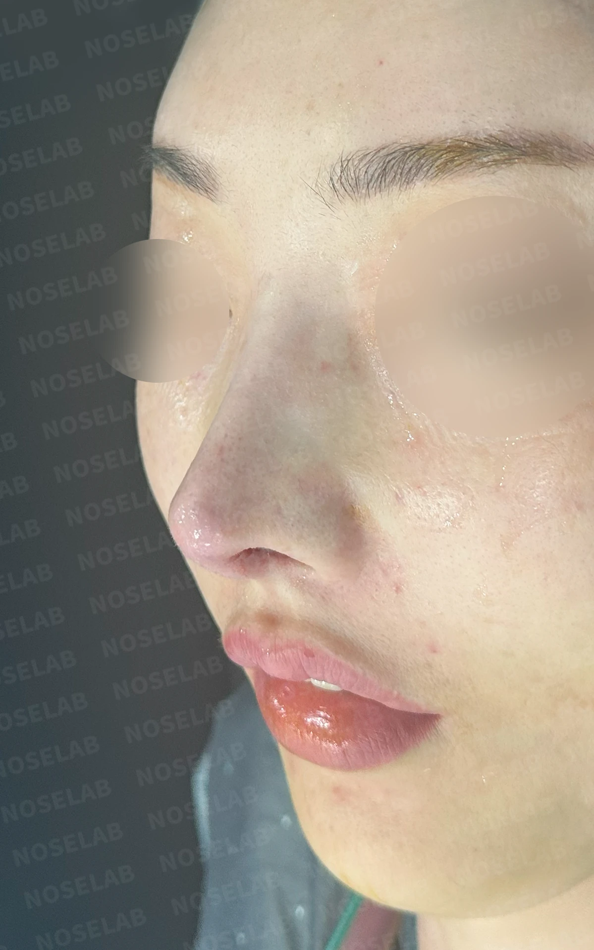 코성형 후 염증이 반복되는 이유와 자가 조직만으로 재건하는 방법 — 수술 직후 0일 정면 , 비스듬한 측면 , 측면 사진입니다. 직후 사진은 부기가 있는 상태로 최종 결과와 다를 수 있습니다.