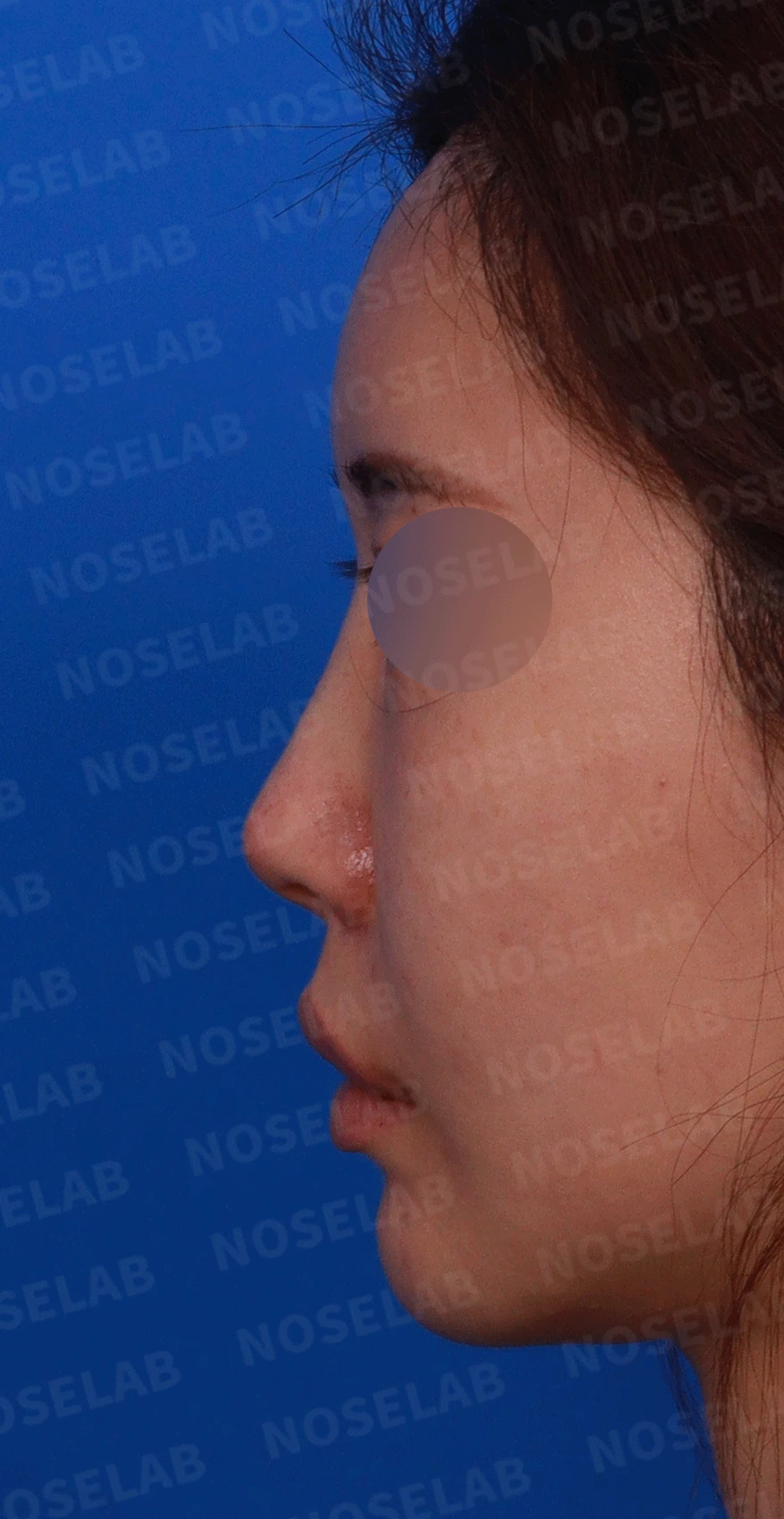 이전 수술로도 달라지지 않는 뭉툭한 코끝, 원인과 재건 방법 — 디자인 상담 정면 , 좌측 비스듬한 측면 , 측면 사진입니다.