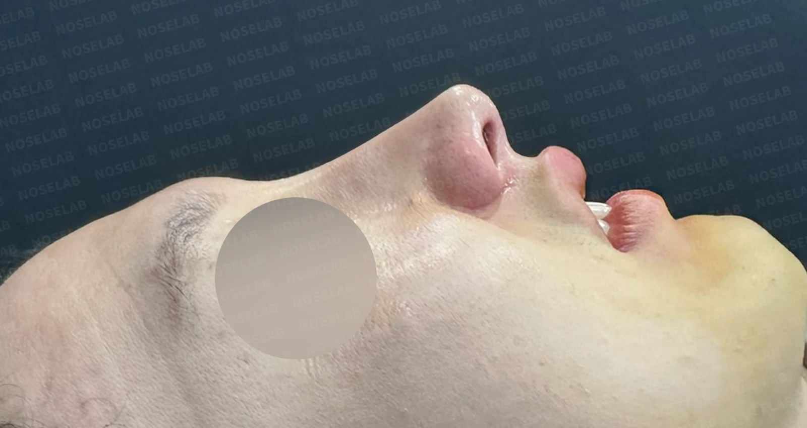 들린코, 작은코, 비순각 교정 사례 - 기능과 미용을 동시에 잡다 — 수술전(좌) 수술직후(우)