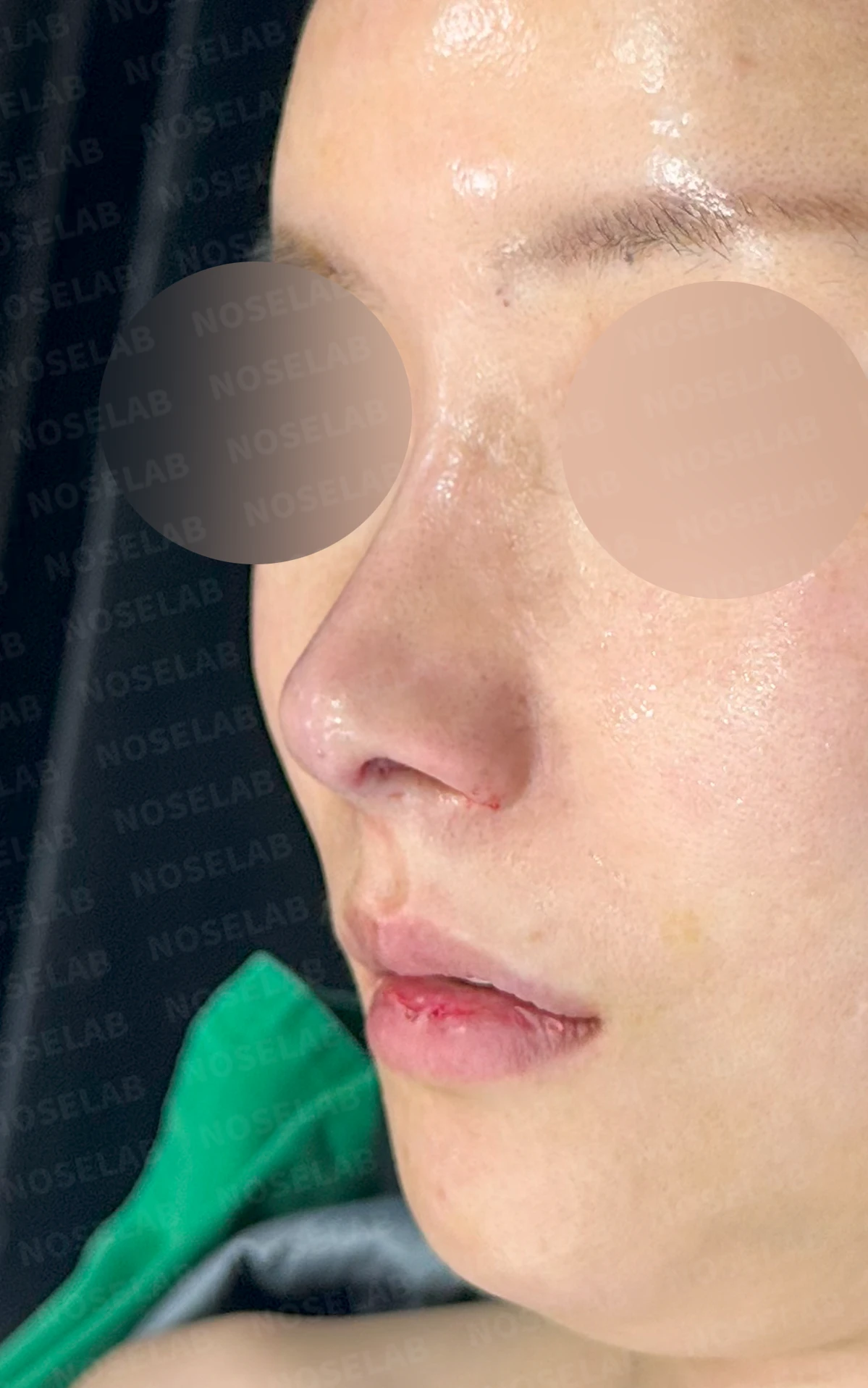 기증 늑연골이 흡수되면 코가 어떻게 변하고, 자가 늑연골 재건은 어떻게 하나 — 수술 직후 0일 정면 , 측면 , 비스듬한 측면 사진 직후 사진은 부기가 있는 상태로 최종 결과와 다를 수 있습니다.