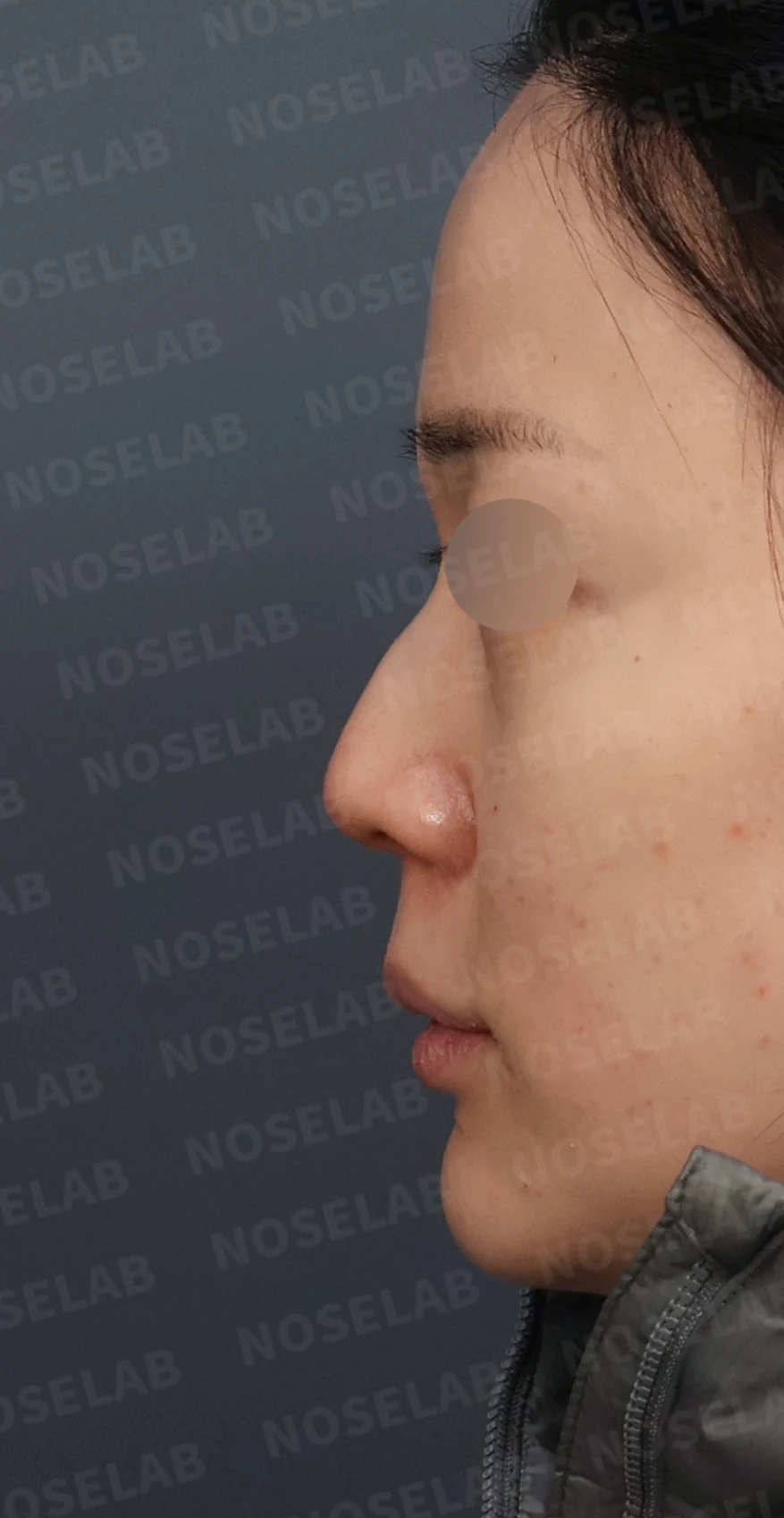 매부리코 교정, 처진 코끝을 오똑하게 바꾸는 비개방 코성형 — 디자인 상담 정면, 좌측 측면, 비스듬한 측면 사진입니다.