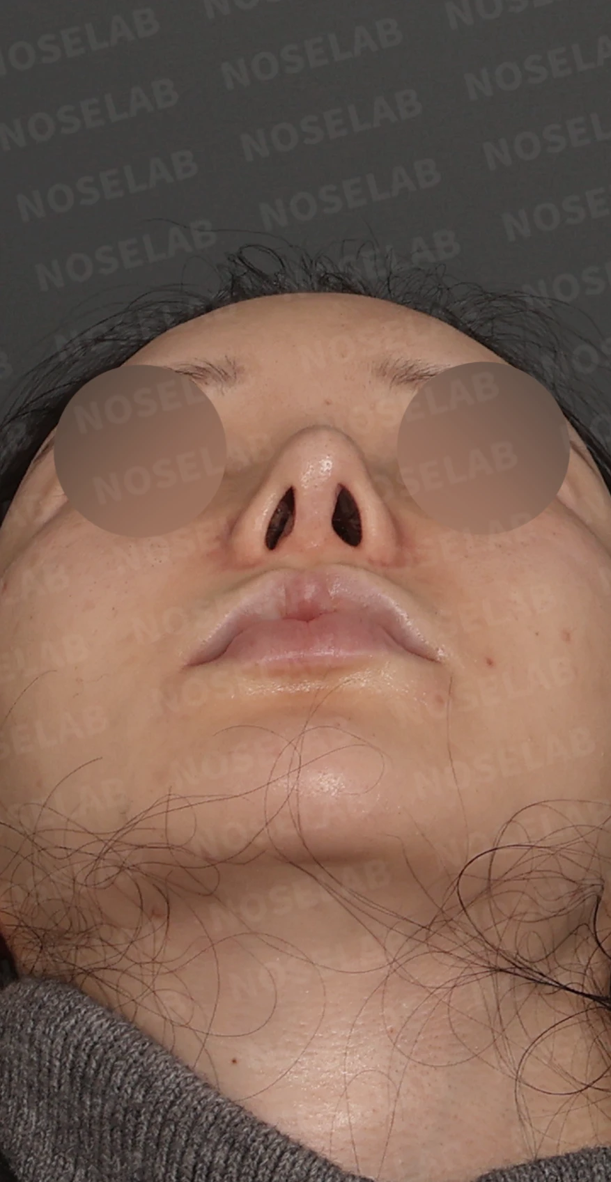 휘어진 코와 비공 비대칭, 자가늑연골 비중격 재건으로 완성한 코재수술 — 디자인 상담 우측 측면, 비스듬한 측면, 비공 사진