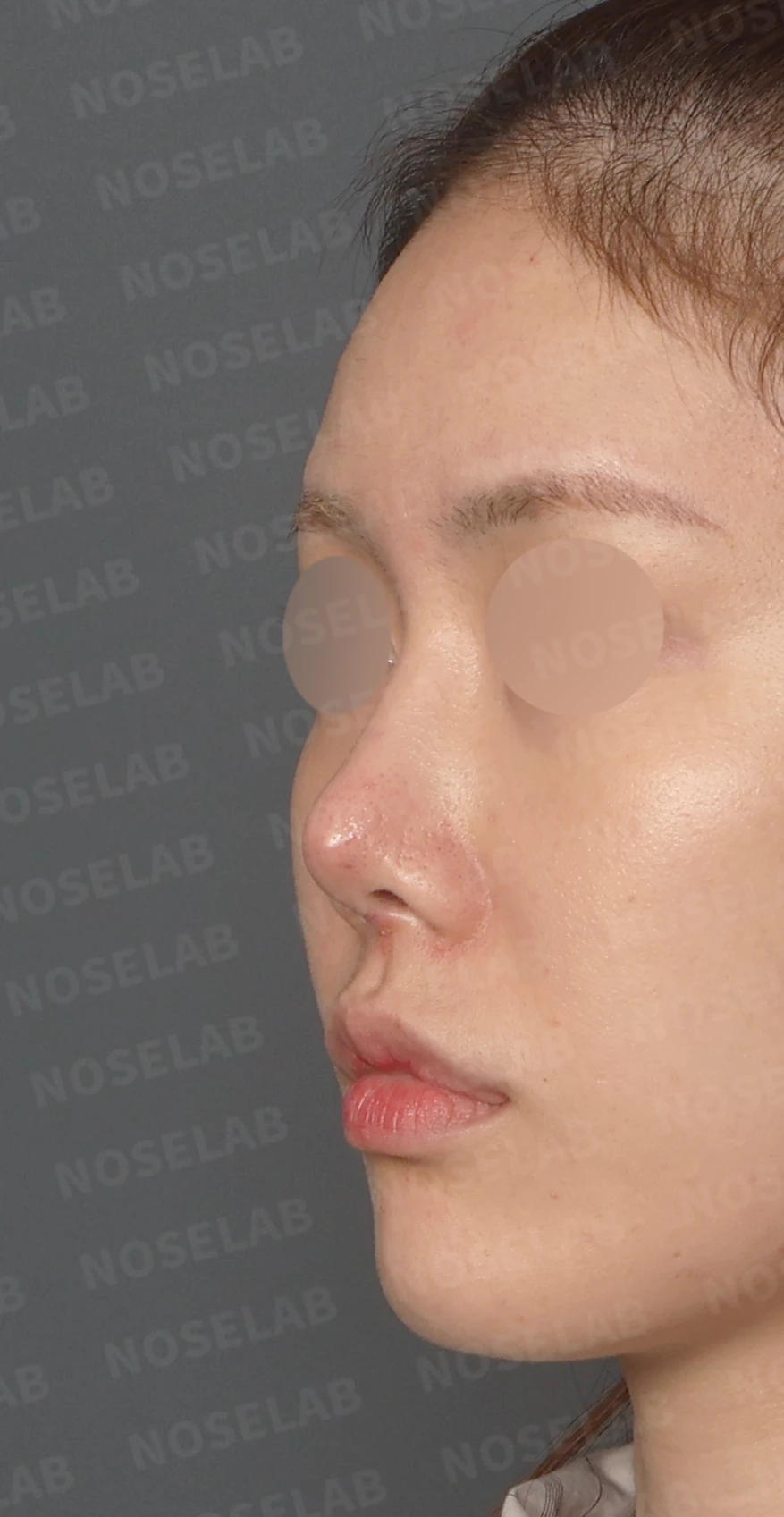 보형물 비침과 비대칭, 자가늑연골 코재수술로 자연스럽게 교정한 사례 — 디자인 상담 정면, 좌측 측면, 비스듬한 측면 사진