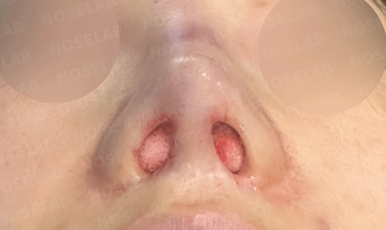 이전 수술로도 달라지지 않는 뭉툭한 코끝, 원인과 재건 방법 — 본문 사진 14