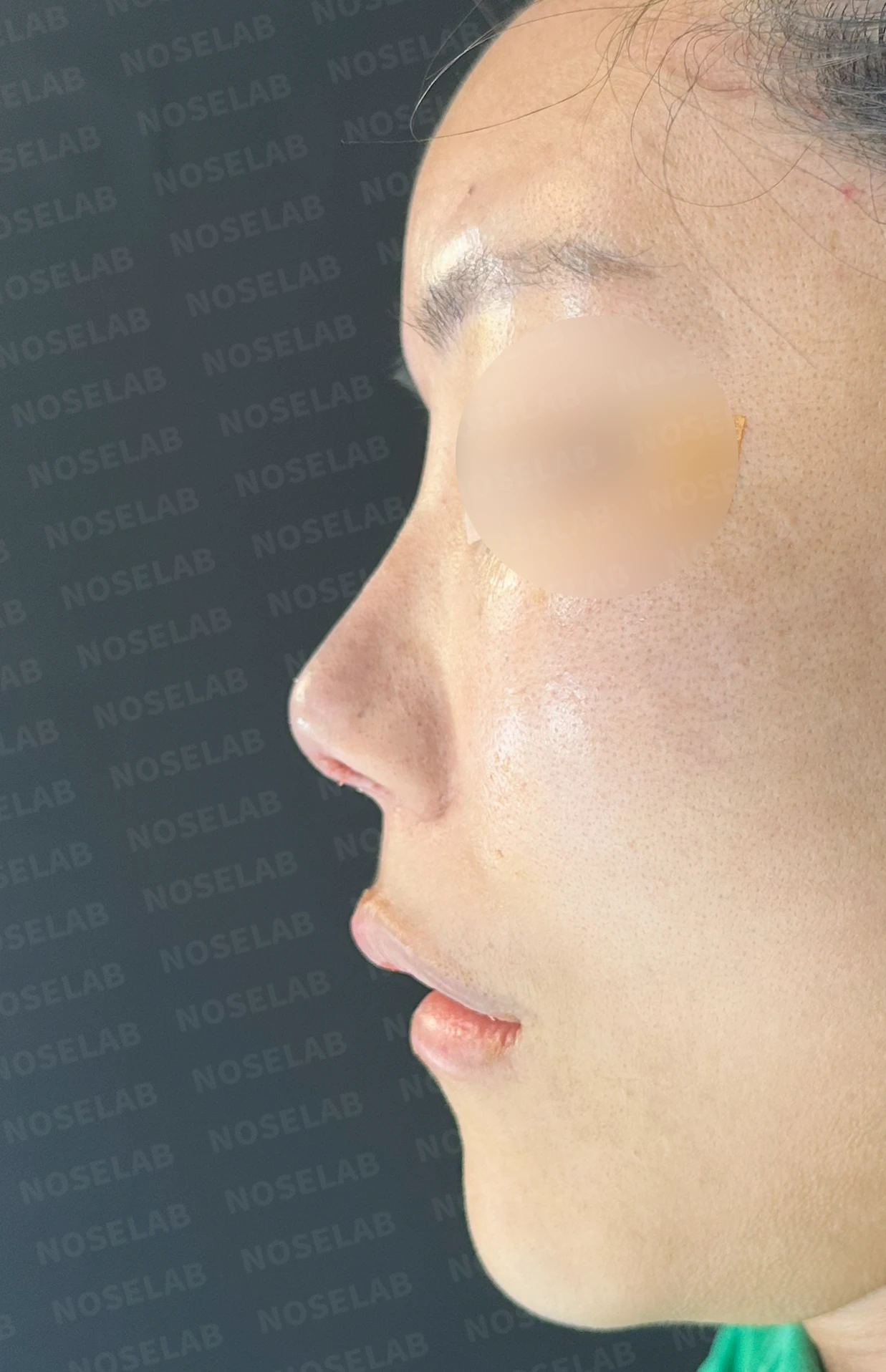 코성형 뒤 감염이 반복되는 이유, 염증 치료와 단계적 재건은 어떻게 하나 — 수술 전 / 수술 직후 0일 직후 사진은 부기가 있는 상태로 최종 결과와 다를 수 있습니다.