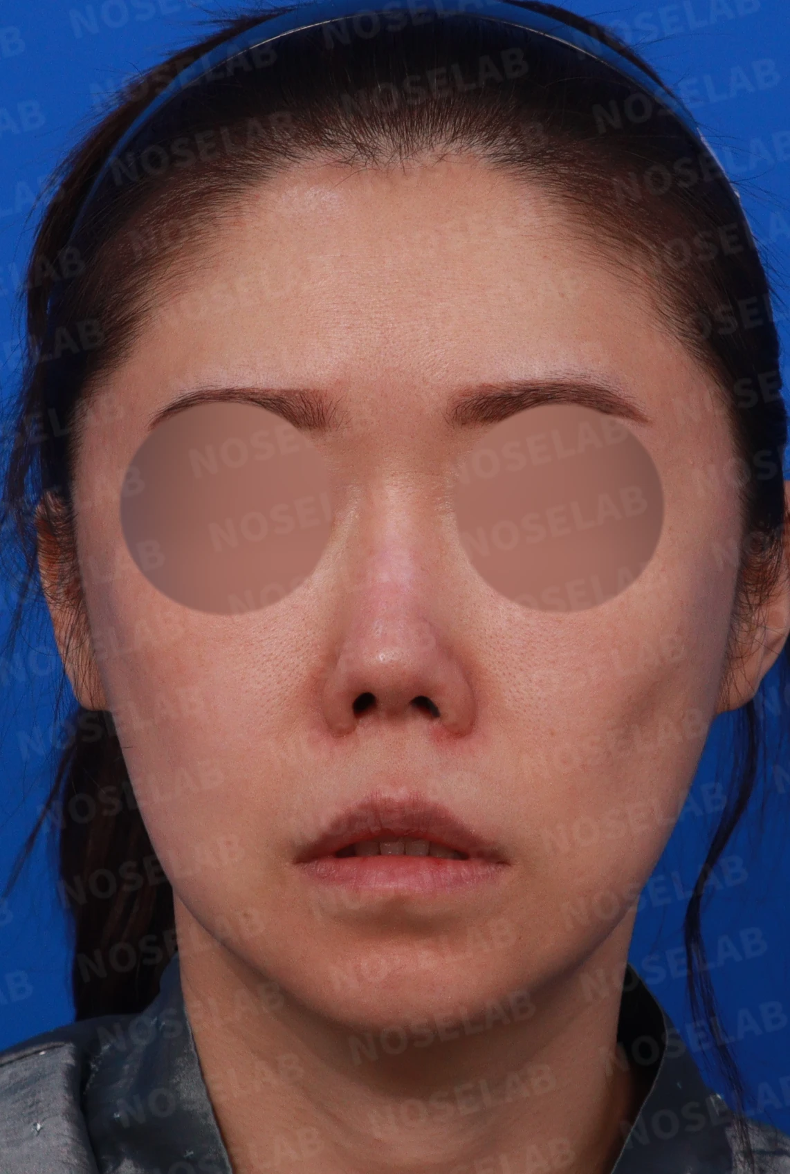 비공 비대칭과 들린코 교정 - 자가늑연골 재건 실제 후기 — 디자인 상담 정면, 좌측 측면, 비스듬한 측면 사진
