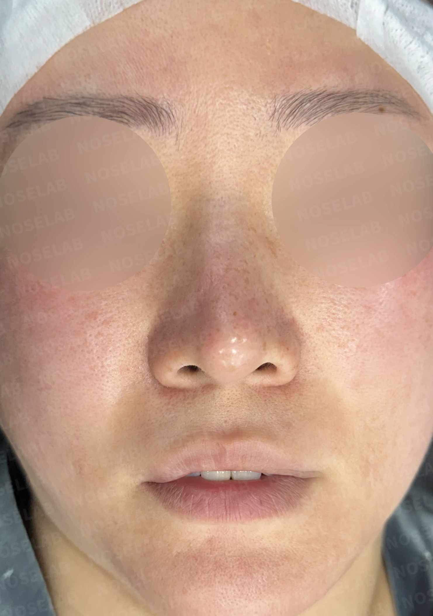 길고 처진 코 교정, 자가늑연골 비중격 재건과 콧대 보형물 교체로 완성한 코재수술 — 전(좌) 직후(우)