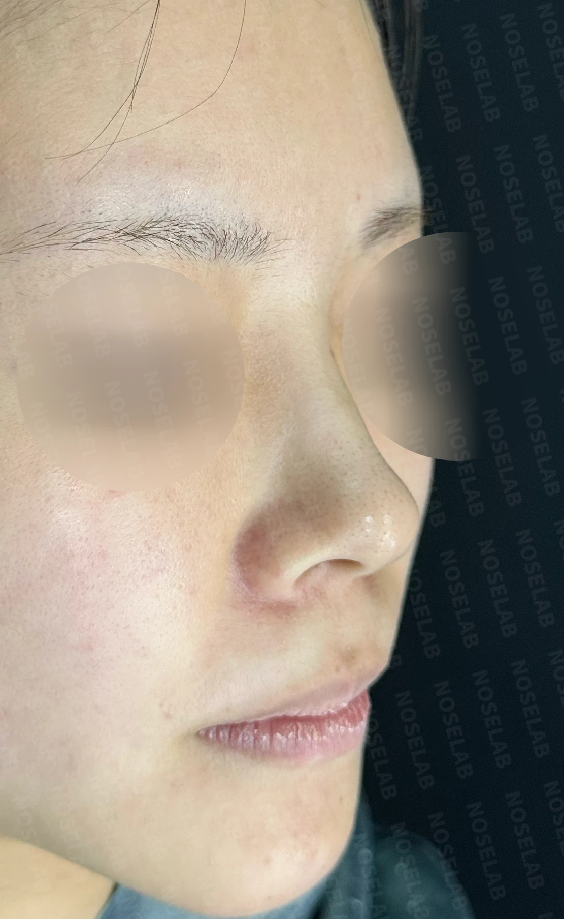 필러 맞고 퍼진 코 교정 방법 — 수술 직후 0일 사진 90도 45도 정면 직후 사진은 부기가 있는 상태로 최종 결과와 다를 수 있습니다.
