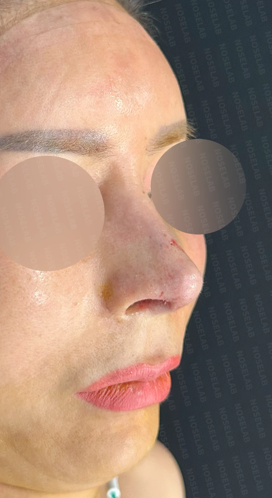 휜코와 뭉툭한 코끝, 콧구멍 비대칭의 비개방 교정 방법 — 수술 직후 0일 정면, 측면, 비스듬한 측면 사진 직후 사진은 부기가 있는 상태로 최종 결과와 다를 수 있습니다.