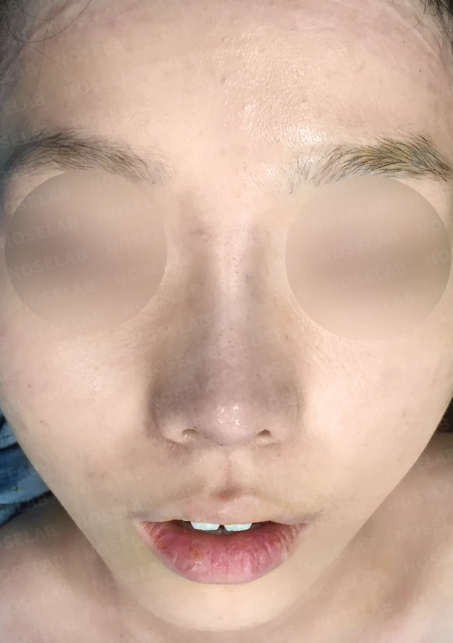 짧은 코의 비개방 교정 방법과 얼굴 비율 — 수술 직후 0일 정면, 측면, 비스듬한 측면 사진입니다. 직후 사진은 부기가 있는 상태로 최종 결과와 다를 수 있습니다.