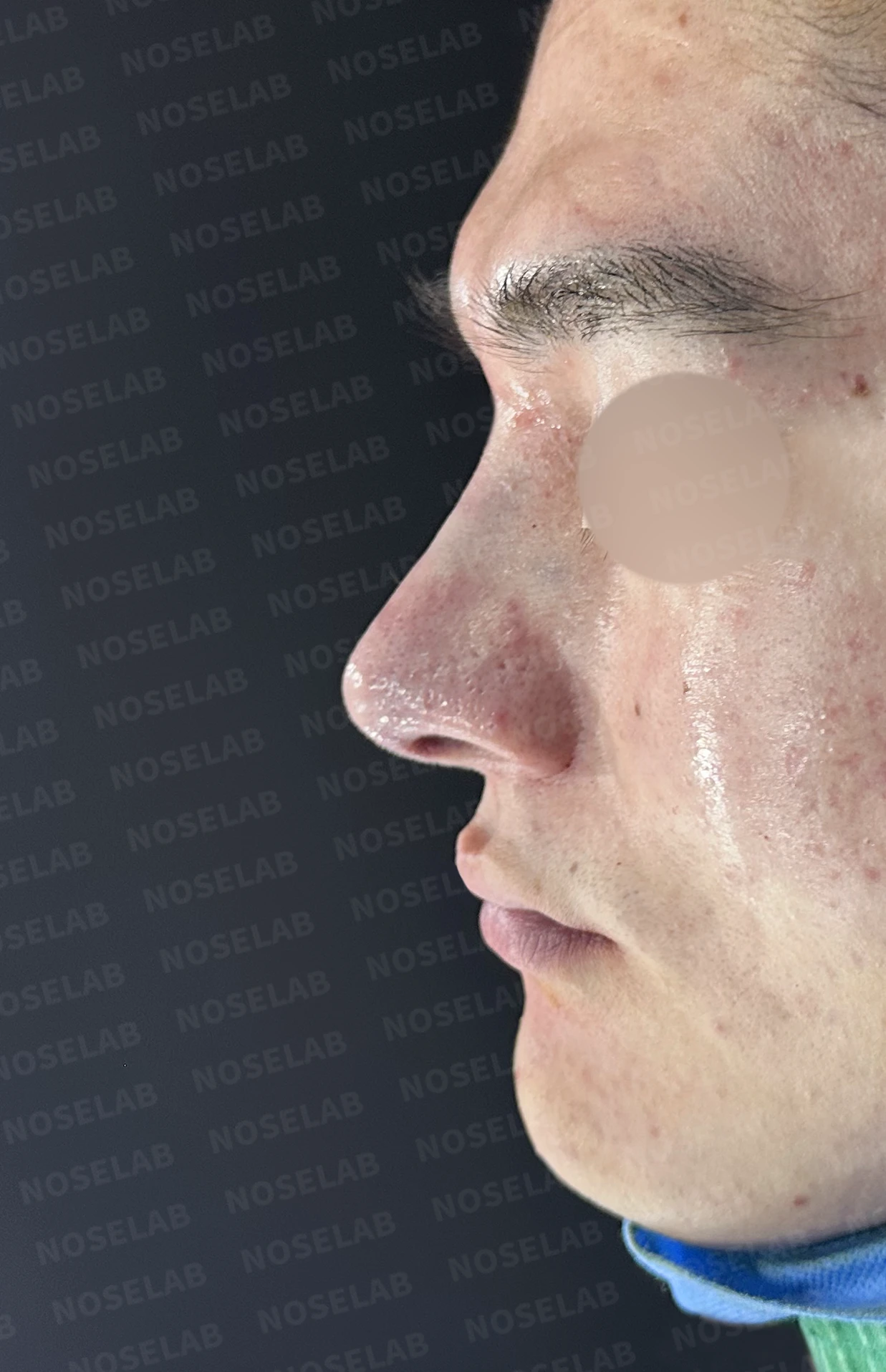 콧대를 더 높이고 싶을 때 무엇이 한계를 만드나, 3D 맞춤 보형물과 자가늑연골 코끝 지지 — 수술 직후 0일 정면, 비스듬한 측면, 측면 사진입니다. 직후 사진은 부기가 있는 상태로 최종 결과와 다를 수 있습니다.