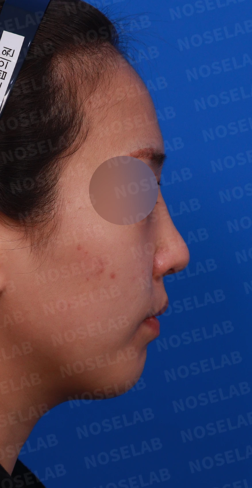 휘어진 코 교정과 비염 개선 - 자가늑연골 재건술 후기 — 디자인 상담 우측 비스듬한 측면, 측면, 비공 사진입니다.