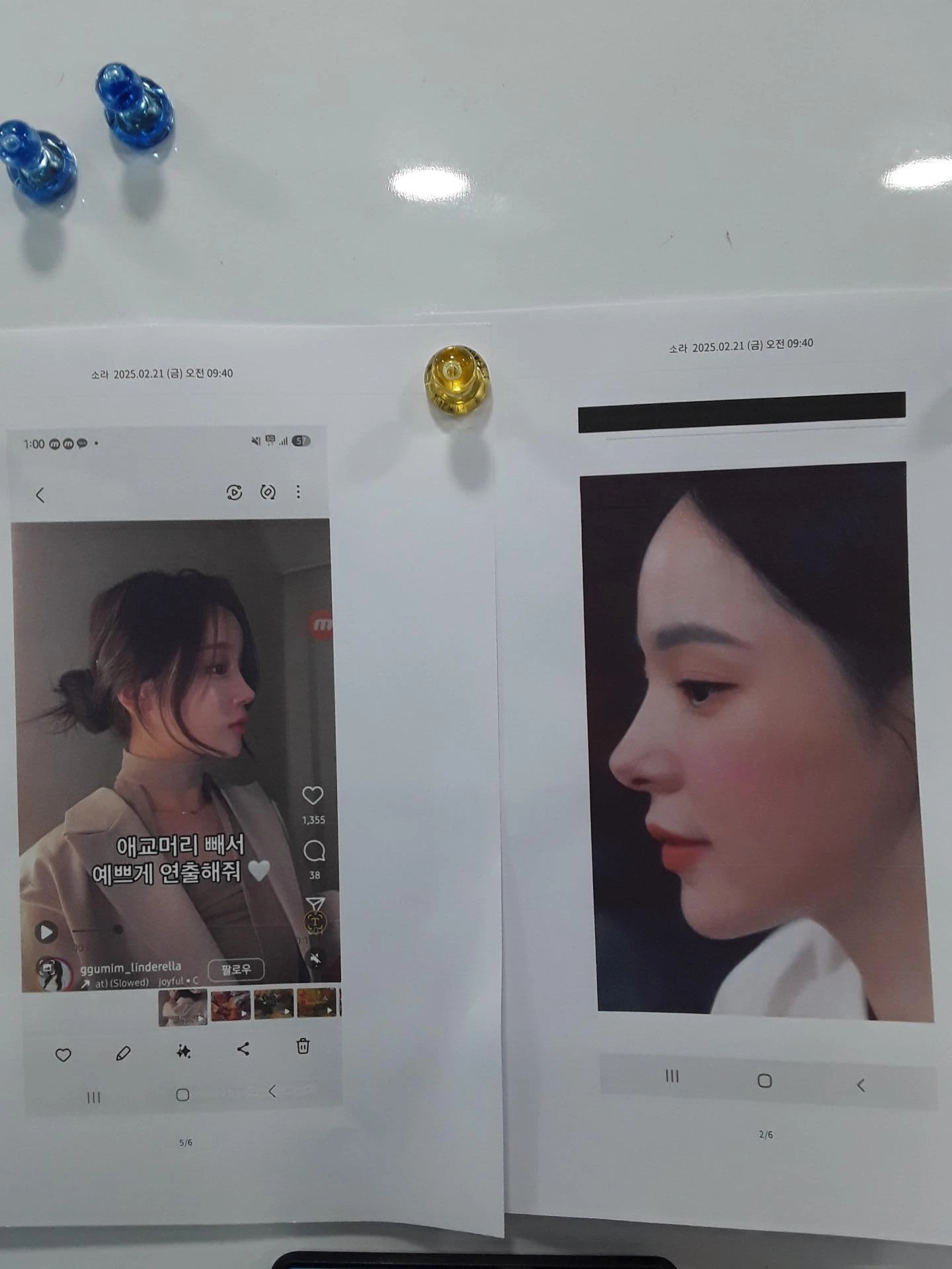 고양이 보형물 제거와 자연스러운 코 재건 - 휘어진 코성형 후기 — 본문 사진 8