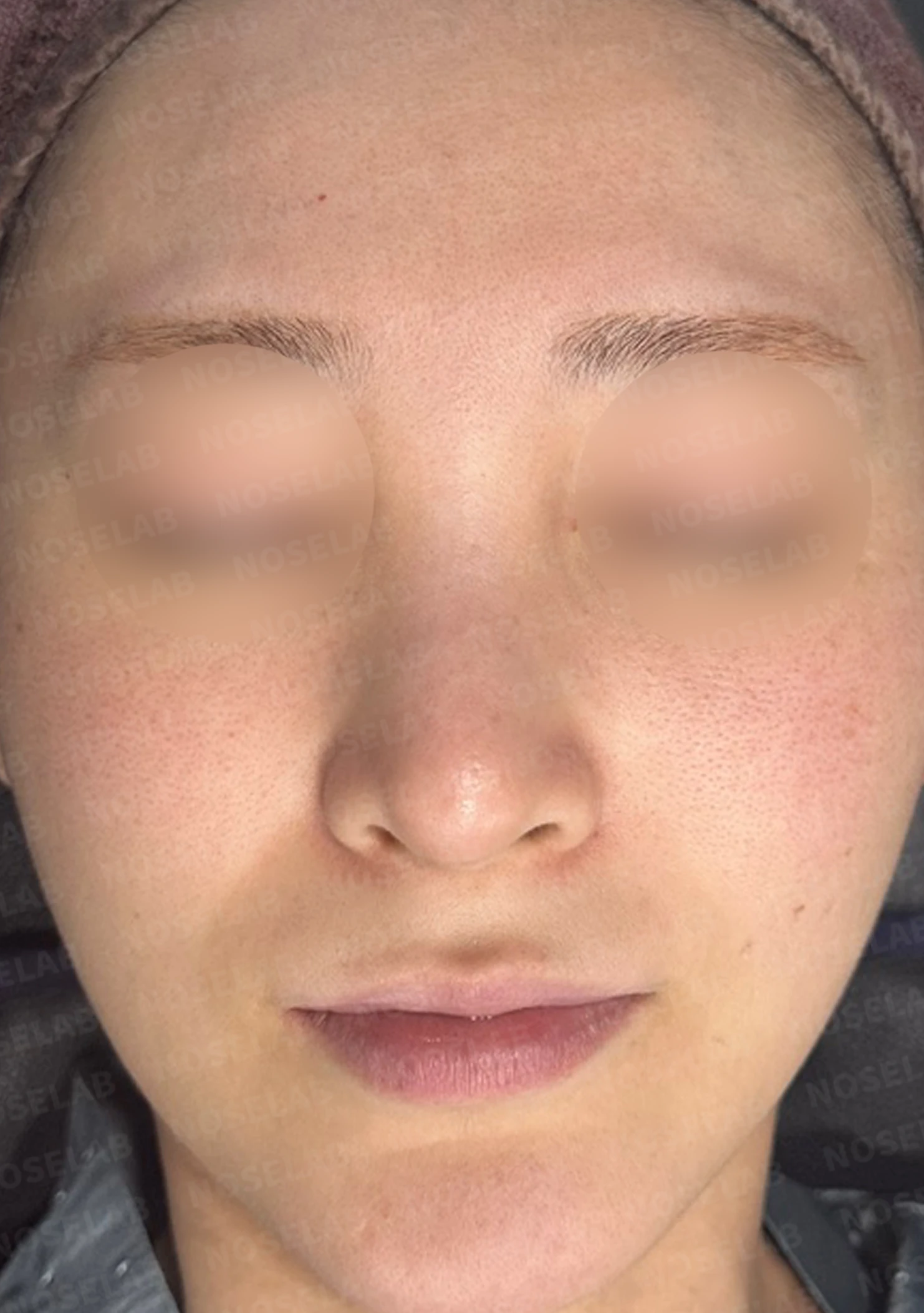 녹이지 않은 코필러가 퍼지고 축농증이 겹칠 때, 제거와 교정은 어떻게 하나 — 수술 전 / 수술 직후 0일 직후 사진은 부기가 있는 상태로 최종 결과와 다를 수 있습니다.