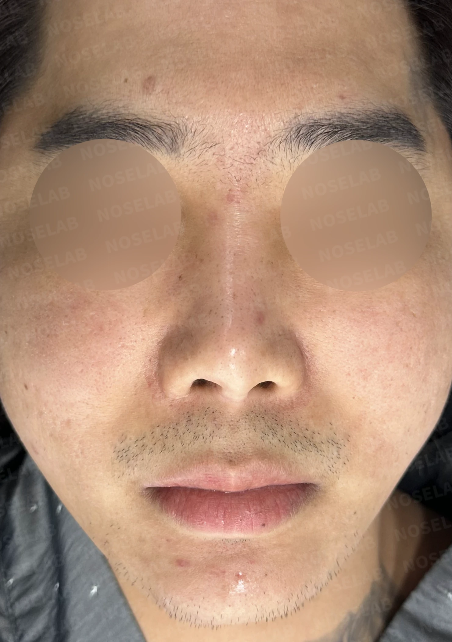 휜코 교정과 비공 비대칭, 자가늑연골로 바로잡은 코재수술 — 전(좌) 직후(후)