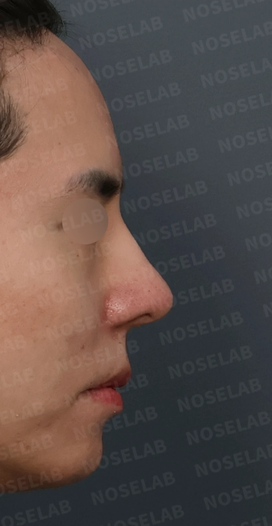코재수술과 코막힘 교정, 기능과 심미 모두 잡은 비개방 코성형 사례 — 디자인 상담 우측 측면, 비스듬한 측면, 비공 사진입니다.