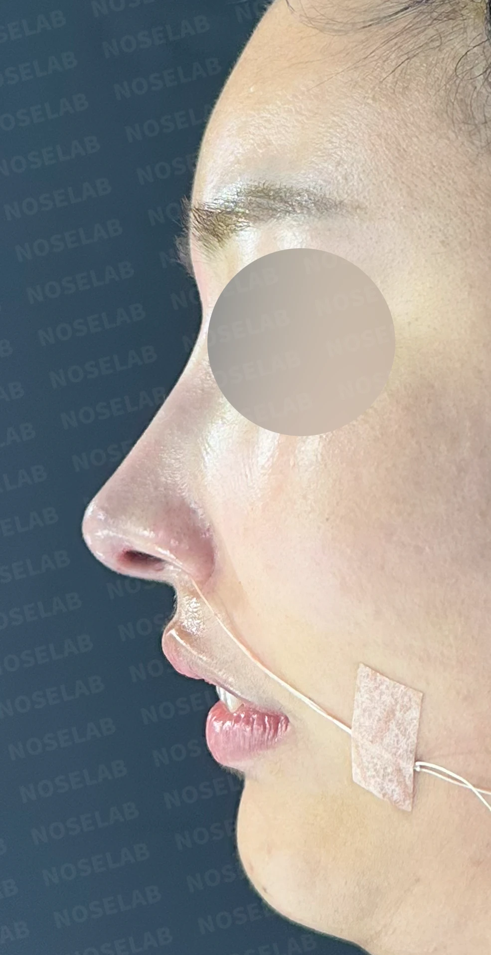 비염 수술을 받았는데도 코막힘이 돌아오는 이유, 구조 교정은 어떻게 하나 — 수술 직후 0일 정면, 측면, 비스듬한 측면 사진입니다. 직후 사진은 부기가 있는 상태로 최종 결과와 다를 수 있습니다.
