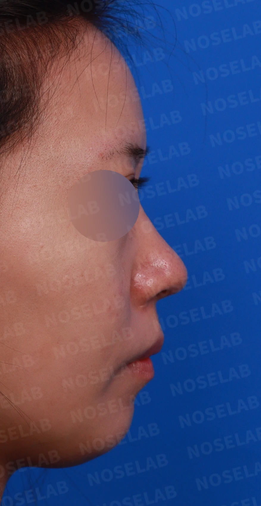 재수술 뒤에도 복코와 퍼진 코끝이 남는 이유, 자가 늑연골 재건은 어떻게 하나 — 디자인 상담 우측 비스듬한 측면, 측면, 비공 사진입니다.