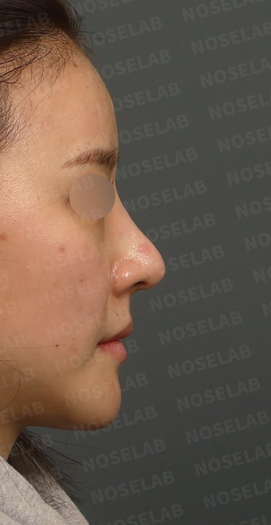 길고 처진 코끝과 코막힘, 자가늑연골로 자연스럽게 교정한 코재수술 — 디자인 상담 우측 비스듬한 측면 / 측면 / 비공