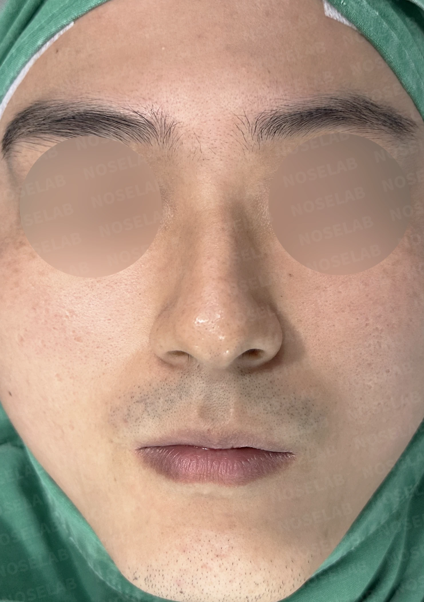 비중격이 휘면 코막힘과 휜 코가 함께 생기는 이유, 재건은 어떻게 하나 — 수술 전 / 수술 직후 0일 직후 사진은 부기가 있는 상태로 최종 결과와 다를 수 있습니다.
