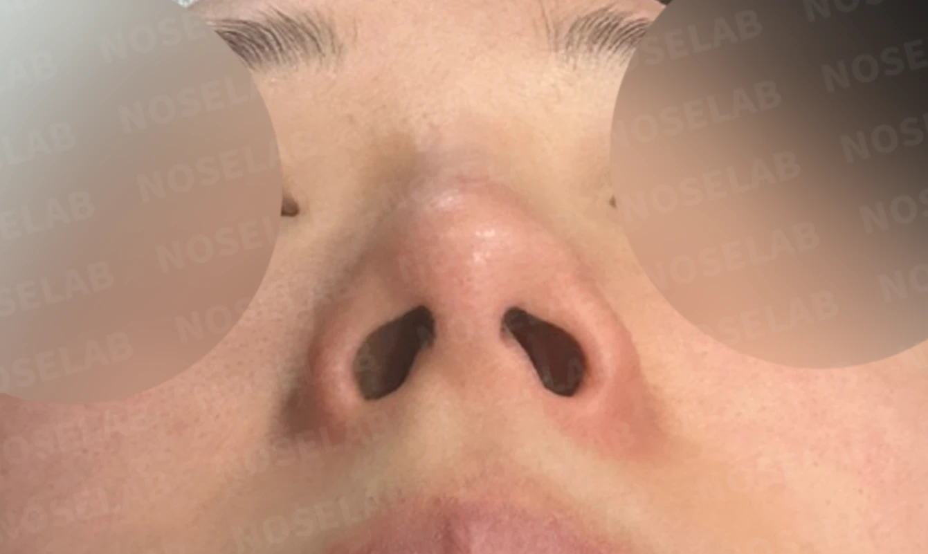 코 필러 뒤에도 휜 코와 코막힘이 남는 이유, 교정은 어떻게 하나 — 수술 전 / 수술 직후 0일 직후 사진은 부기가 있는 상태로 최종 결과와 다를 수 있습니다.