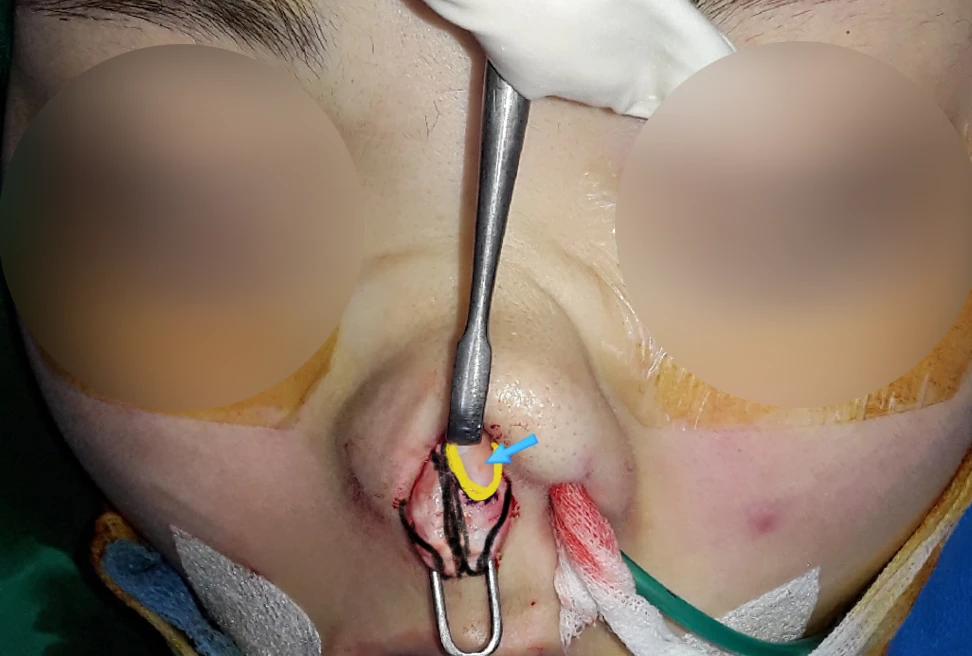 퍼진 코 개선과 콧구멍 비대칭 교정 방법 — 본문 사진 8