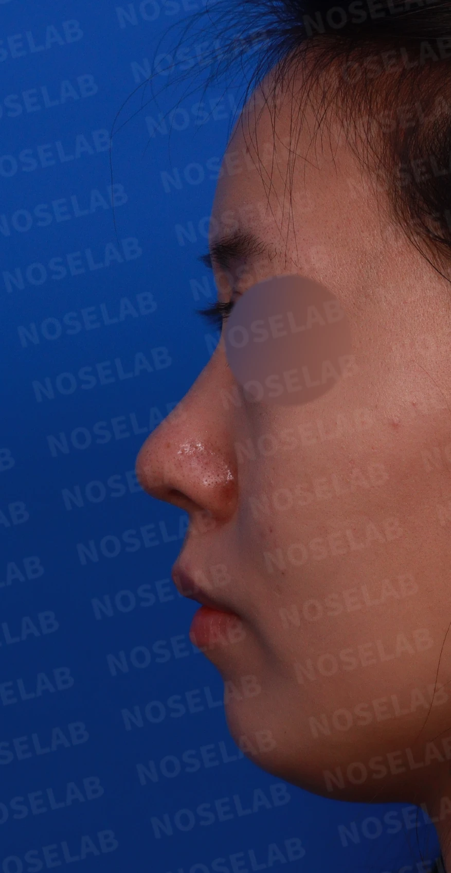재수술 뒤에도 복코와 퍼진 코끝이 남는 이유, 자가 늑연골 재건은 어떻게 하나 — 디자인 상담 정면, 좌측 측면, 비스듬한 측면 사진