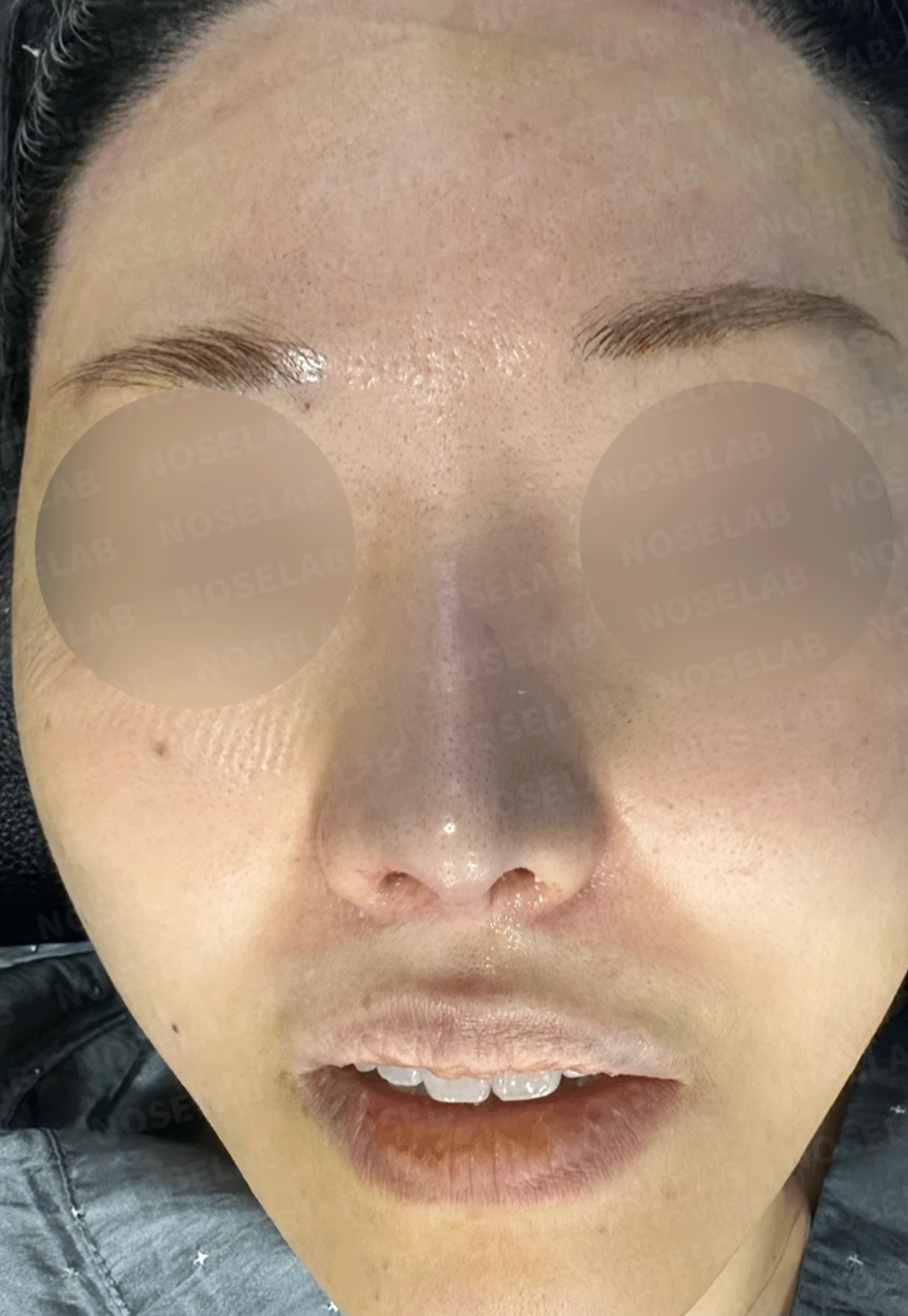 인공진피가 흡수되며 콧대가 낮아지고 퍼지는 이유 — 본문 사진 8