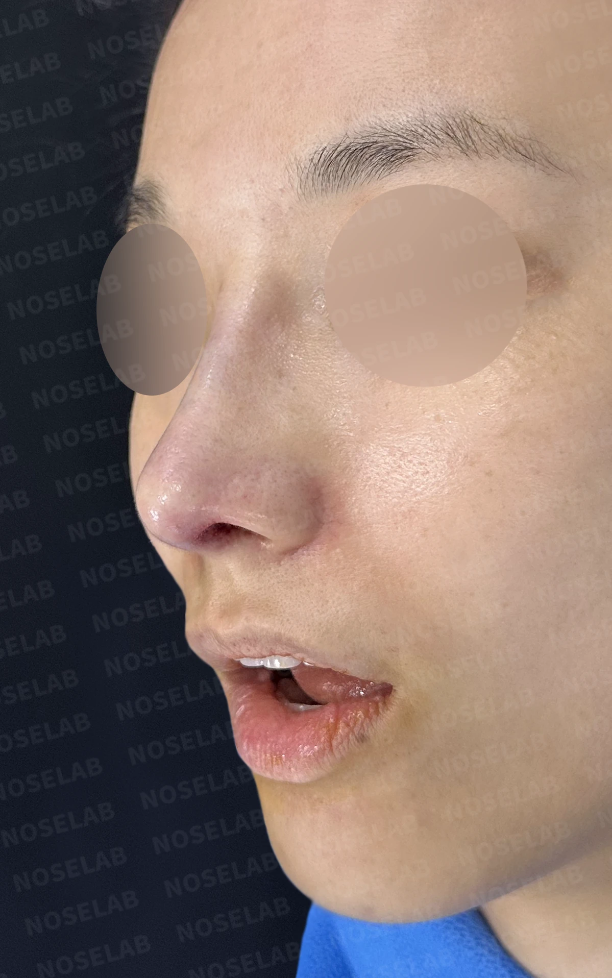 콧대 인공진피가 매부리로 남는 이유와 제거 후 재건 방법 — 수술 직후 0일 정면, 비스듬한 측면, 측면 사진입니다. 직후 사진은 부기가 있는 상태로 최종 결과와 다를 수 있습니다.