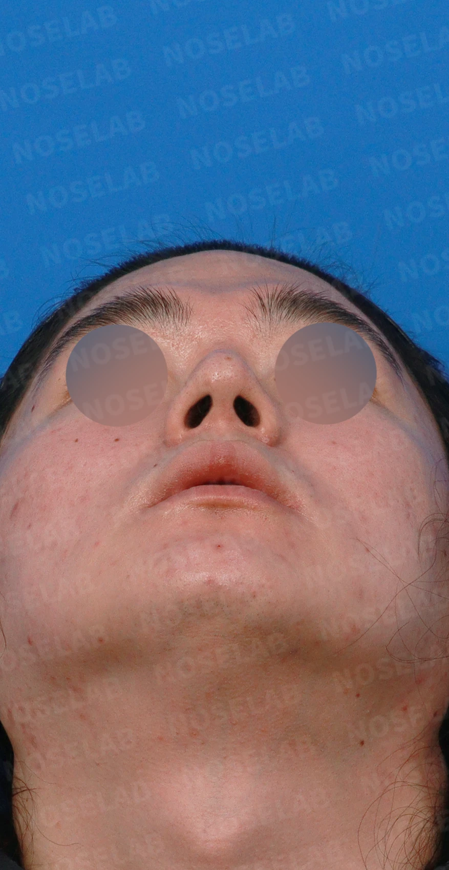 콧대를 더 높이고 싶을 때 무엇이 한계를 만드나, 3D 맞춤 보형물과 자가늑연골 코끝 지지 — 디자인 상담 우측 측면, 비스듬한 측면, 비공 사진입니다.