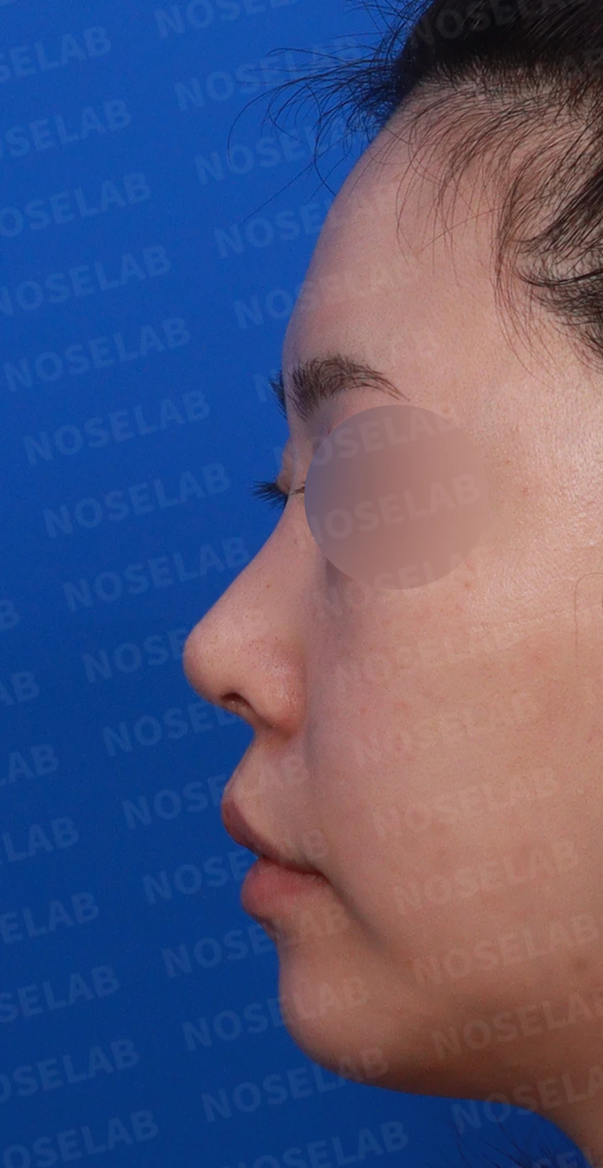 비중격 연골을 과도하게 채취하면 생기는 문제와 재건 방법 — 디자인 상담 정면, 좌측, 비스듬한 측면 사진입니다.