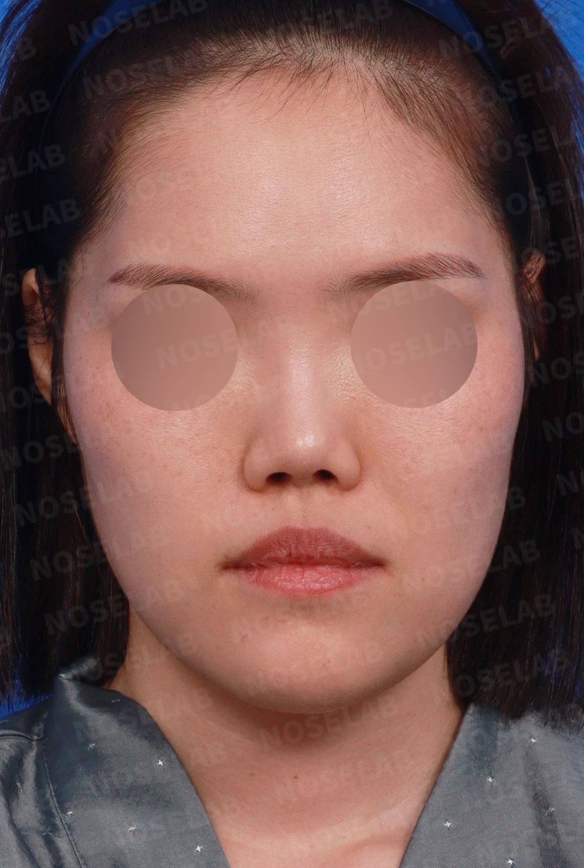 짧고 들린 코와 휜 코가 함께 생기는 이유, 비중격 연장 교정은 어떻게 하나 — 디자인 상담 정면, 좌측 측면, 비스듬한 측면 사진입니다.
