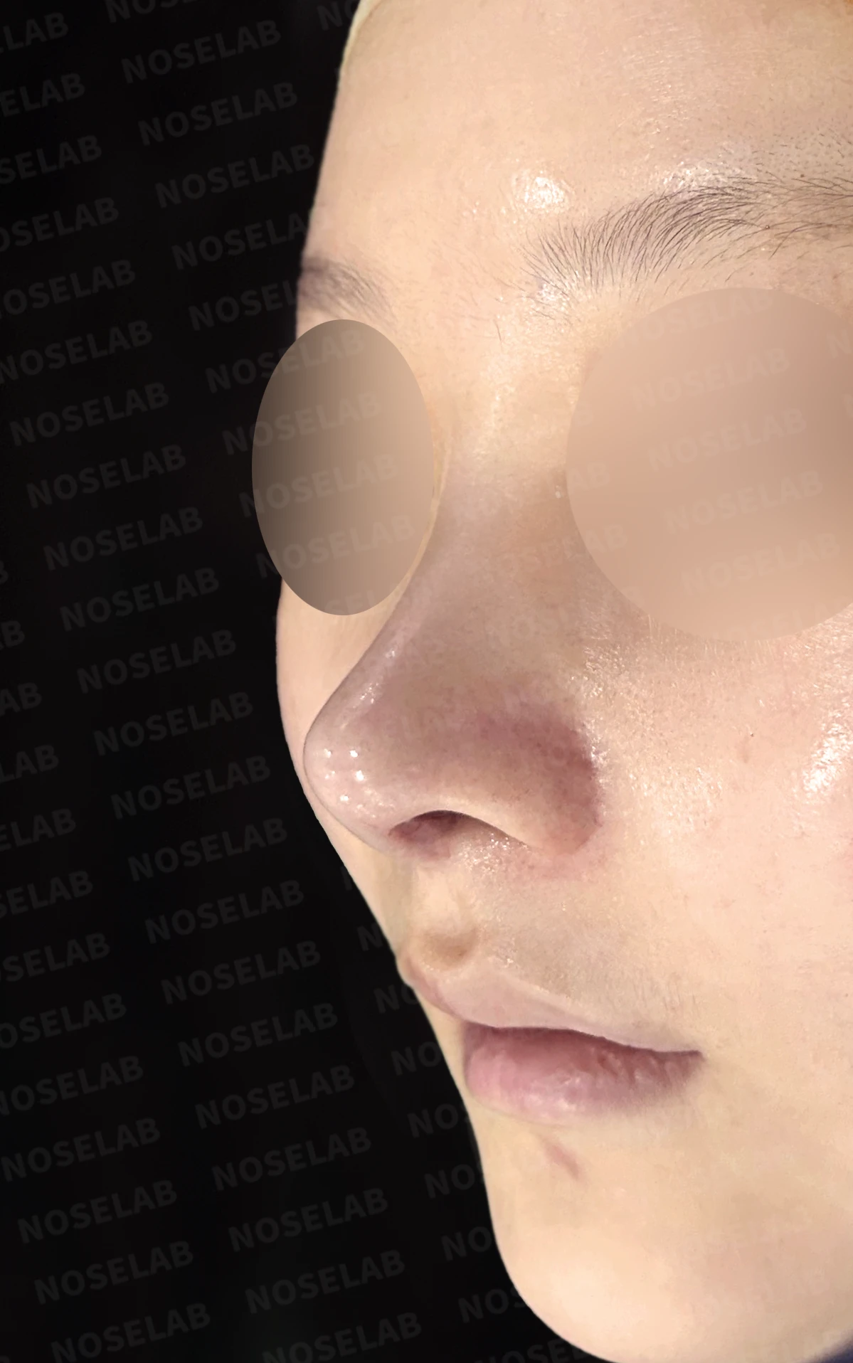 휘어진 코와 복코, 자가늑연골 비중격 재건으로 안전하게 교정한 코재수술 — 직후 정면, 비스듬한 측면, 측면 사진입니다.