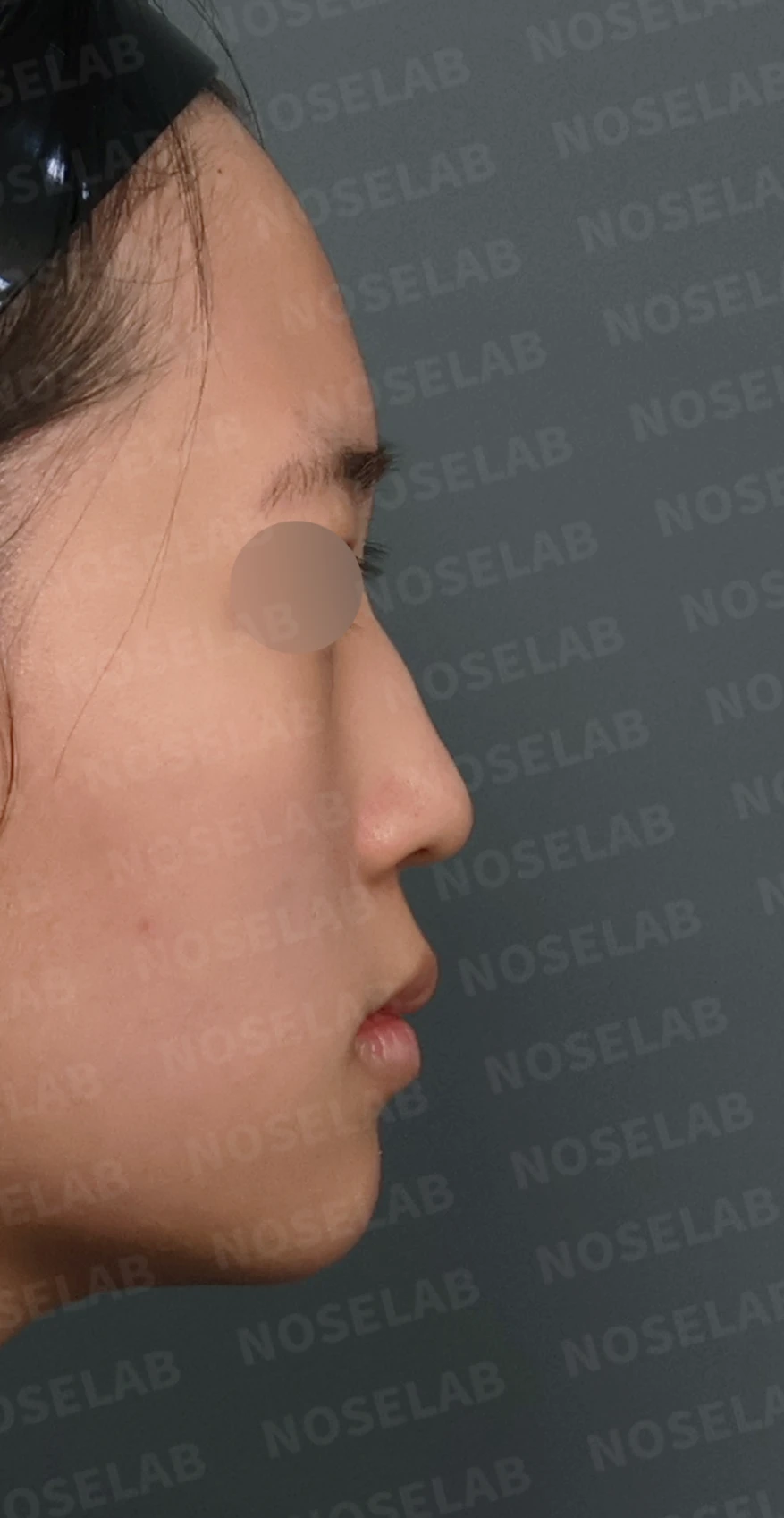 작은 콧날개 연골과 처진 코끝, 자가늑연골과 외측절골술로 자연스럽게 교정 — 디자인 상담 우측 측면, 비스듬한 측면, 비공 사진입니다.