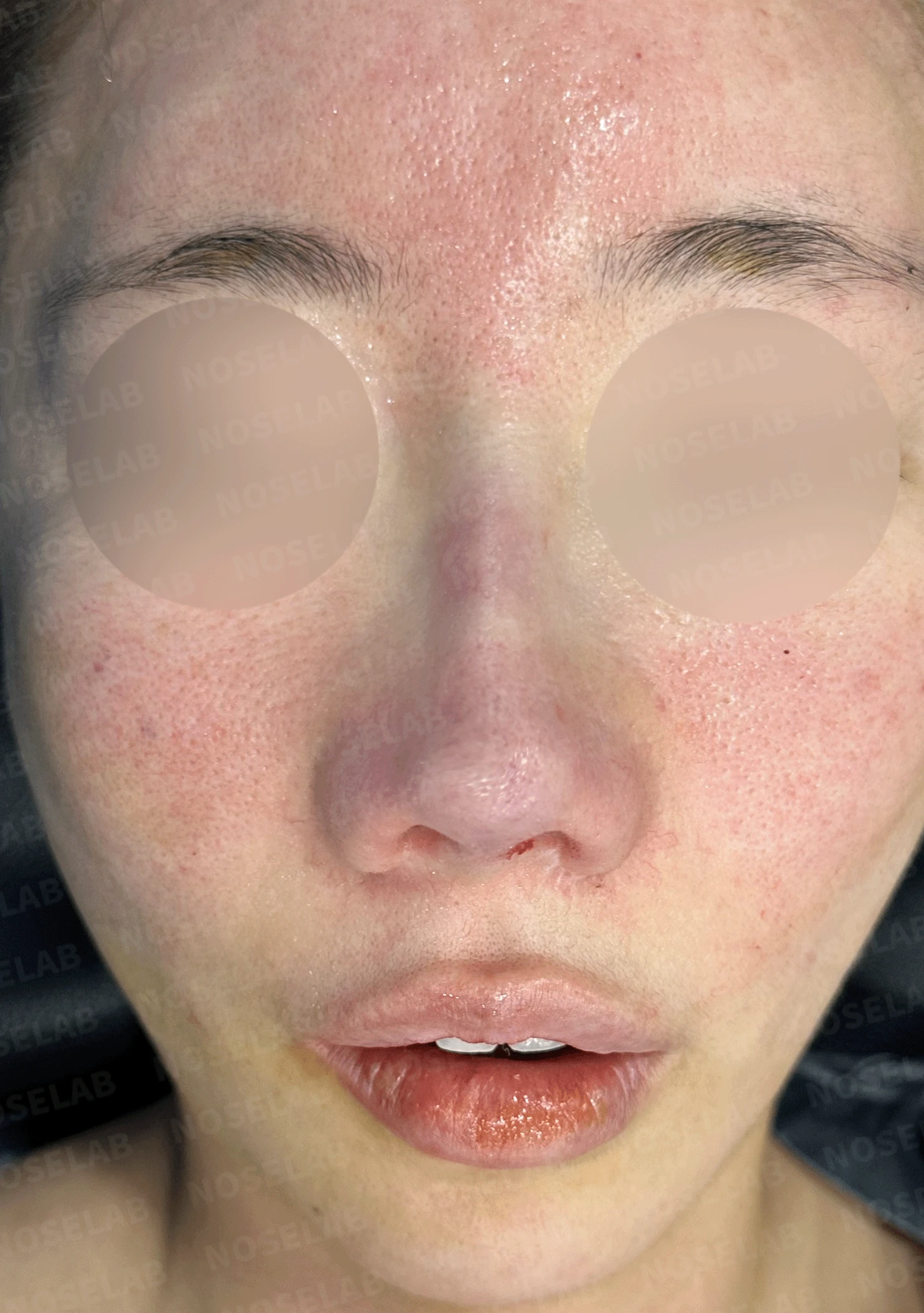오래된 코 수술 뒤 비주가 함몰되고 코끝이 뭉툭해지는 이유와 재건 방법 — 본문 사진 8
