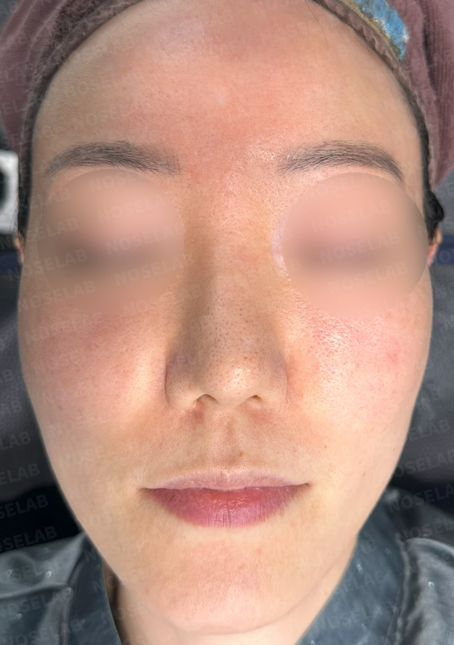 오래된 고어텍스 구축과 비중격 천공이 생기는 이유, 재건은 어떻게 하나 — 수술 전 / 수술 직후 0일 직후 사진은 부기가 있는 상태로 최종 결과와 다를 수 있습니다.