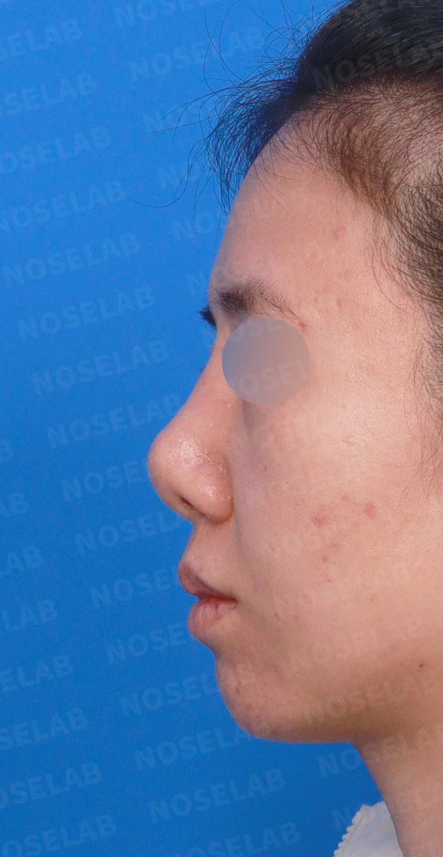 이전 수술 뒤 코가 딱딱해지고 짧아지는 구축, 왜 생기고 어떻게 재건하나 — 디자인 상담 정면, 좌측 측면, 비스듬한 측면 사진입니다.