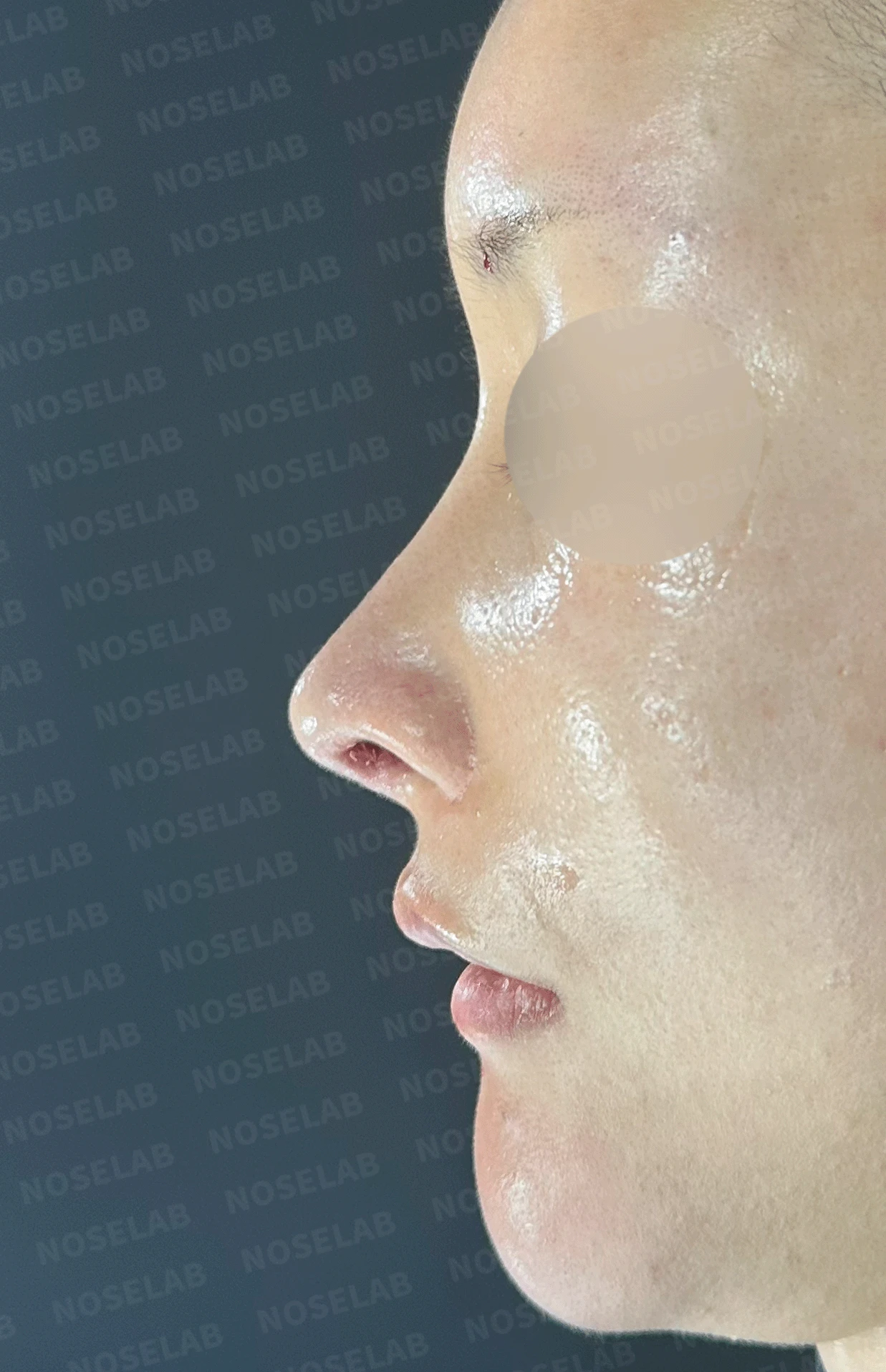 후비루와 코끝 처짐이 함께 나타나는 이유, 비중격 연장과 기능 수술은 어떻게 하나 — 본문 사진 10