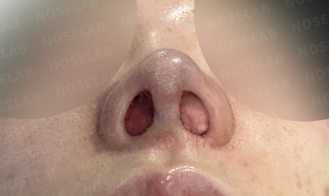 휘어진 코와 비공 비대칭, 자가늑연골 비중격 재건으로 완성한 코재수술 — 전(좌) 직후(후)
