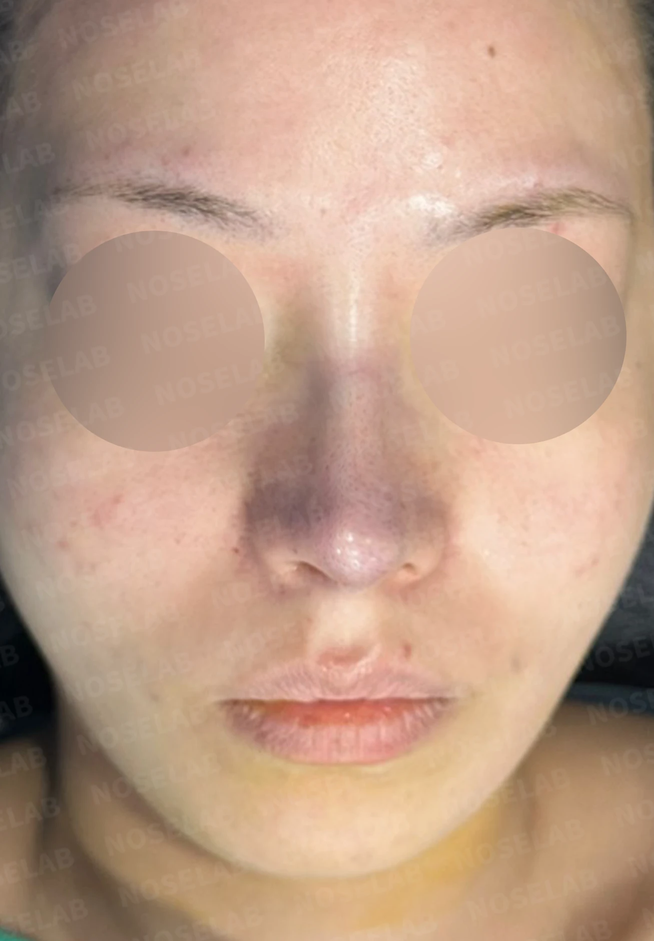 재수술 뒤에도 복코와 퍼진 코끝이 남는 이유, 자가 늑연골 재건은 어떻게 하나 — 수술 직후 0일 정면, 측면, 비스듬한 측면 사진입니다. 직후 사진은 부기가 있는 상태로 최종 결과와 다를 수 있습니다.