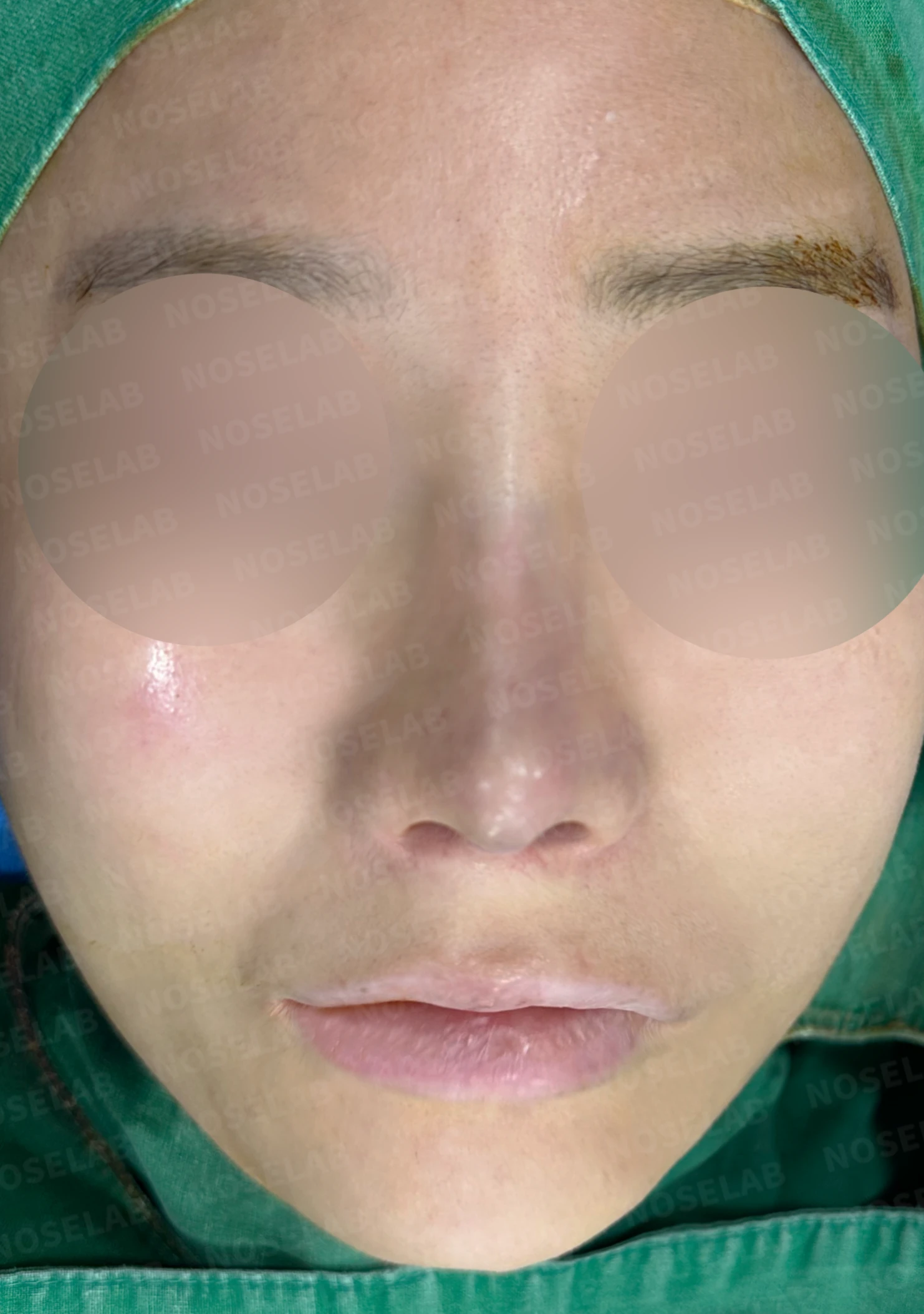비중격 천공이 생기면 무엇이 문제이고 어떻게 재건하나 — 수술 직후 0일 정면, 비스듬한 측면, 측면 사진입니다. 직후 사진은 부기가 있는 상태로 최종 결과와 다를 수 있습니다.