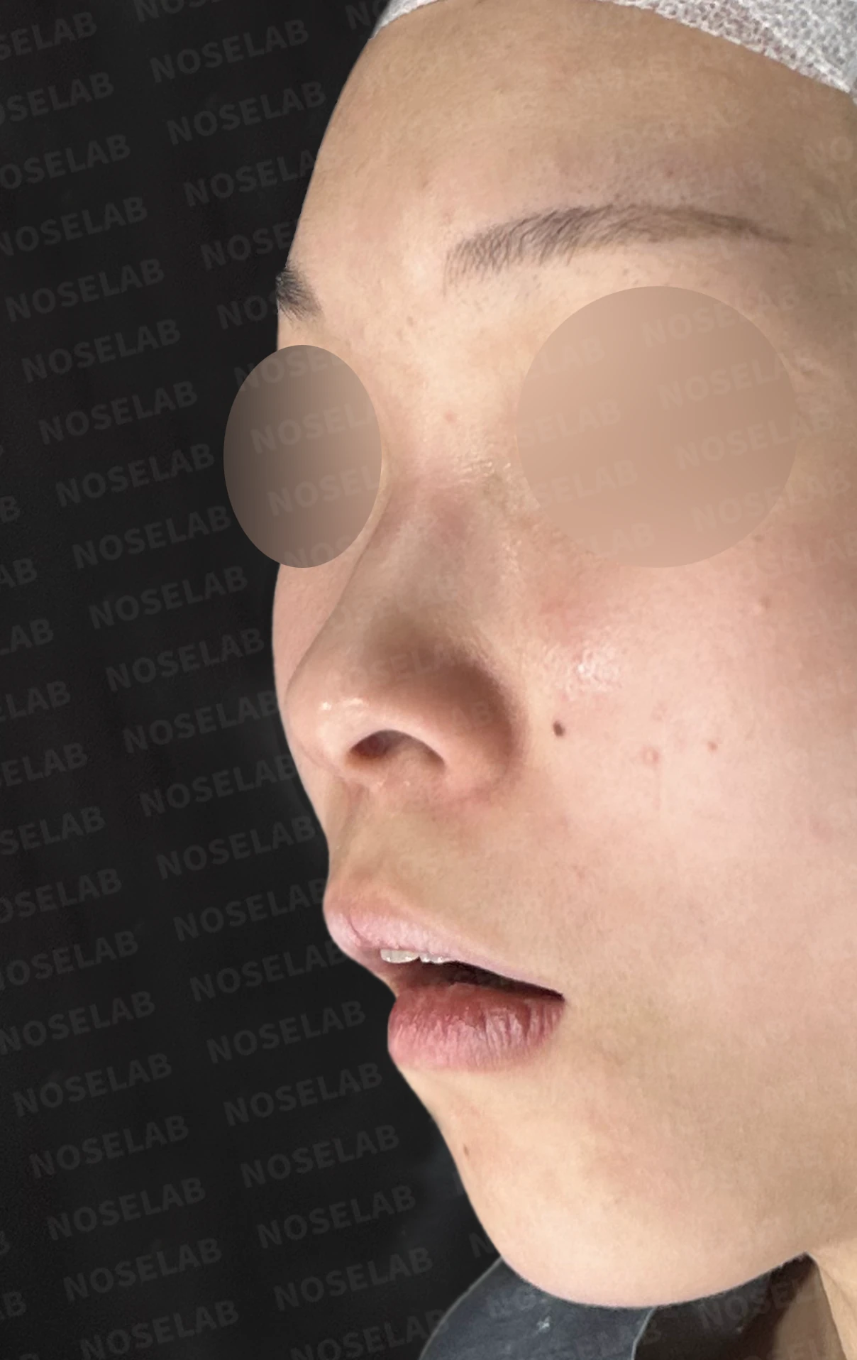 낮고 퍼진 코, 기증늑연골과 실리콘 보형물로 자연스러운 코 라인 완성 — 전(좌) 직후(후)