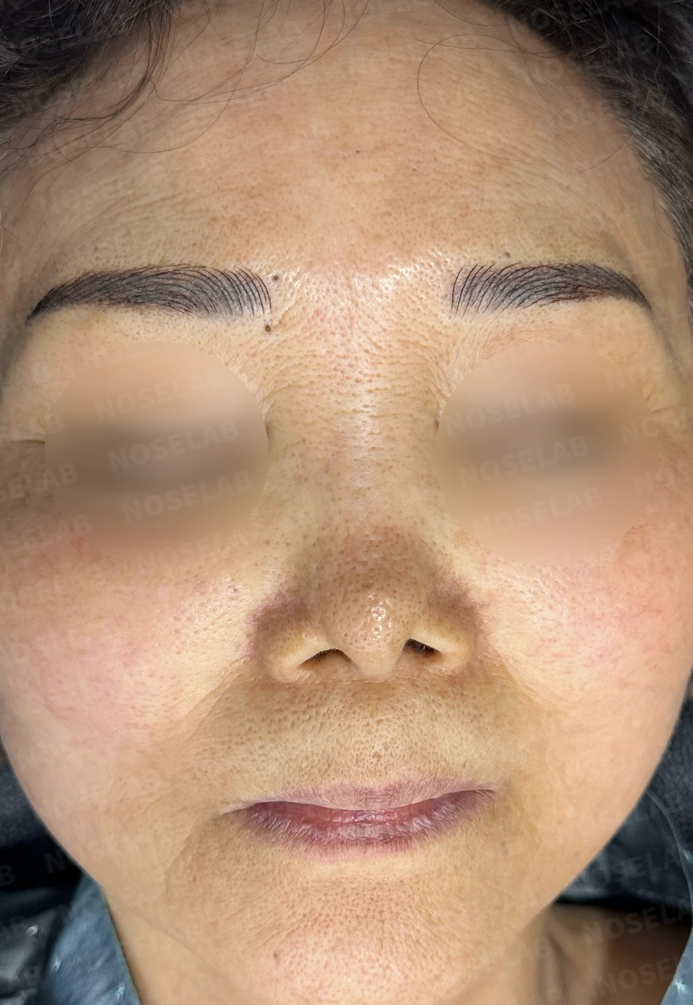 비중격 천공이 있는 코의 재수술 계획 — 수술 전 / 수술 직후 0일 직후 사진은 부기가 있는 상태로 최종 결과와 다를 수 있습니다.