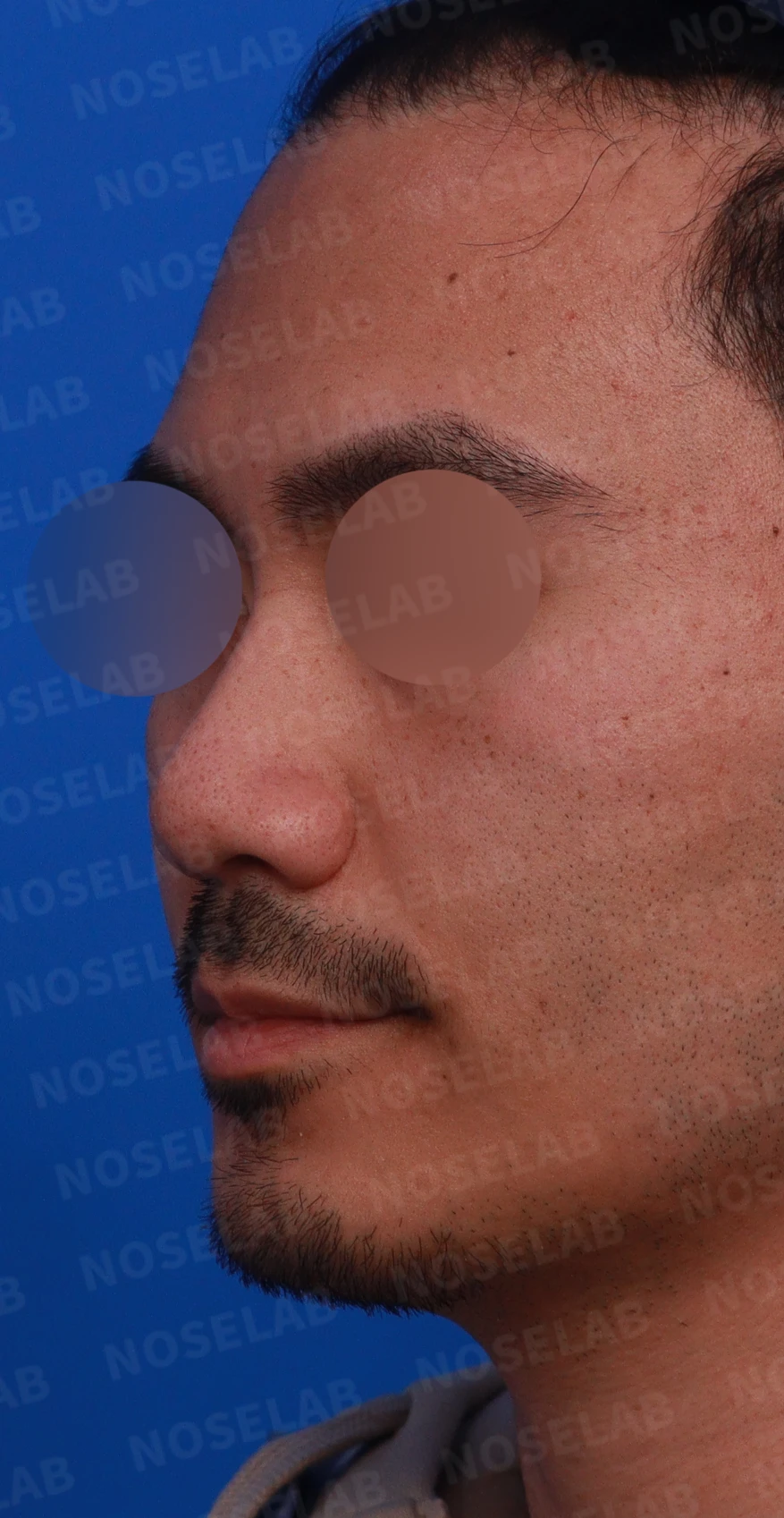 복코에 비공 비대칭과 코막힘이 함께 오는 이유, 직반 라인 교정은 어떻게 하나 — 디자인 상담 정면, 좌측 측면, 비스듬한 측면 사진