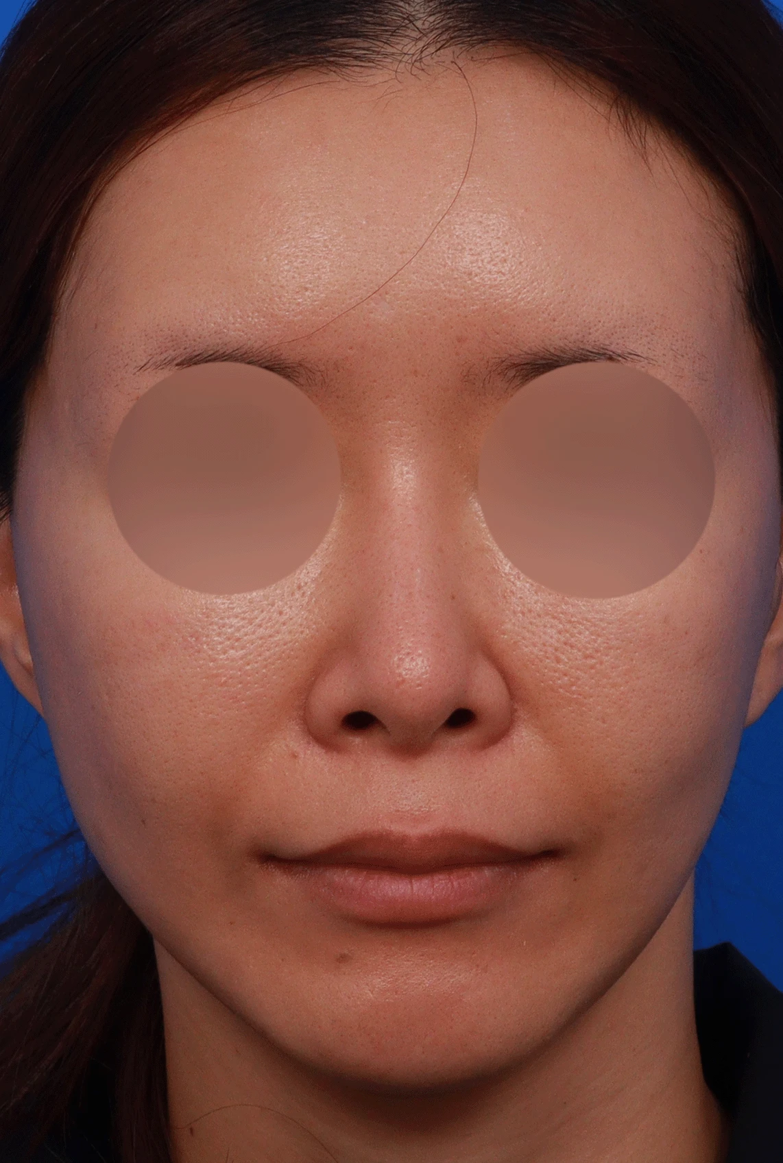후비루와 코끝 처짐이 함께 나타나는 이유, 비중격 연장과 기능 수술은 어떻게 하나 — 디자인 상담 정면 , 좌측 측면 ,비스듬한 측면 사진