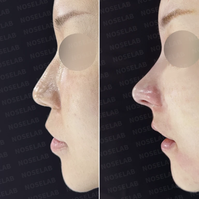 뭉툭한 복코, 오똑하고 작아 보이는 코로 자연스럽게 교정하다 — 전후 비교