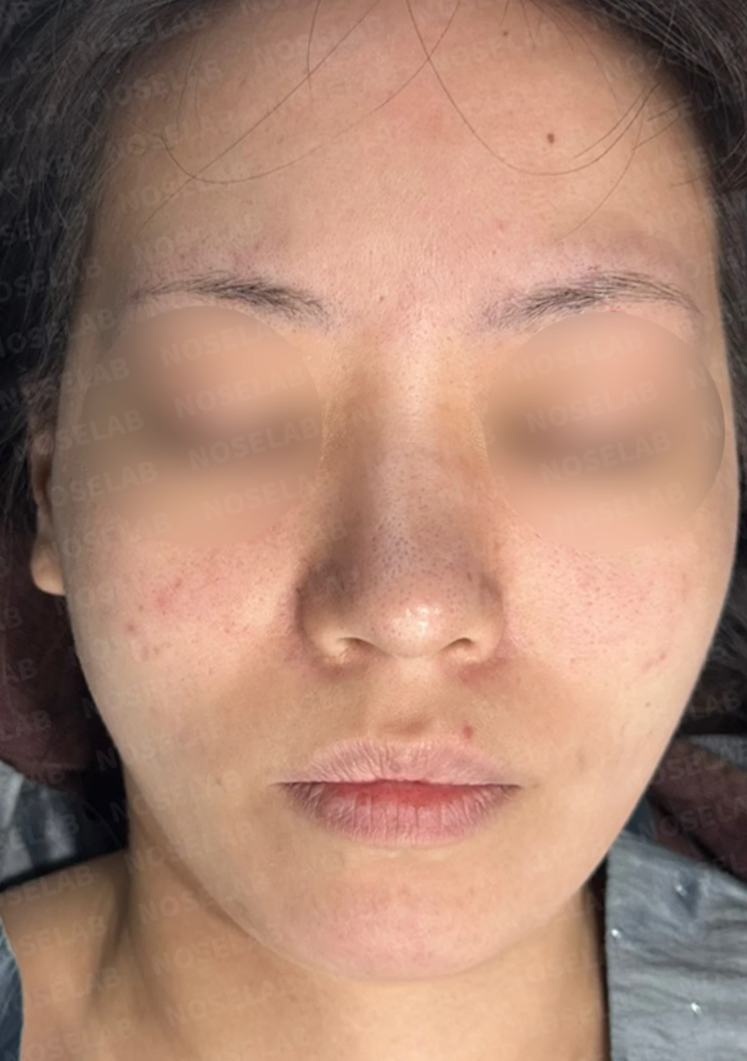 재수술 뒤에도 복코와 퍼진 코끝이 남는 이유, 자가 늑연골 재건은 어떻게 하나 — 수술 전 / 수술 직후 0일 직후 사진은 부기가 있는 상태로 최종 결과와 다를 수 있습니다.