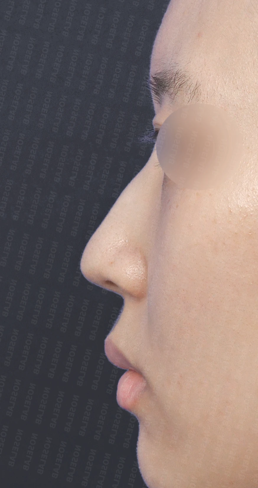 매부리코에 코의 휨과 비공 비대칭이 함께 오는 이유, 비중격 연골 교정은 어떻게 하나 — 수술 전 / 수술 직후 0일 직후 사진은 부기가 있는 상태로 최종 결과와 다를 수 있습니다.